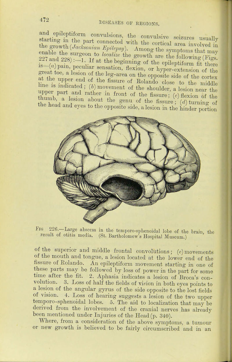 DISEASES OF REGIONS. ^ epileptiform convulsions, the convulsive seizures usuallv W™g S^z.Part COnnectGd With thc cor^ azU i LCd^ the growth (Jbcfaonto, ^fl^). Among the symptomthat muv s If™ , ' the beginning 0f the epileptiform fit there is-f/Opain, peculiar sensation, flexion, or hyper-extension of thl great toe, a lesion of the leg-area on the opposite side of he cortex at the upper end of the fissure of Eolando close to the middle hue is indicated ; (b) movement of the shoulder, a lesion ne^ the upper part and rather in front of the fissure; (c) flex on o he W) a lesion about the genu of the fissu^V ^ turning o the head and eyes to the opposite side, a lesion in the hinder poi tion Fig 226.—Large abscess in the temporo-sphenoidal lobe of the brain, the result of otitis media. (St. Bartholomew's Hospital Museum.) of the superior and middle frontal convolutions; (e) movements of the mouth and tongue, a lesion located at the lower end of the fissure of Eolando. An epileptiform movement starting in one of these parts may be followed by loss of power in the part for some time after the fit. 2. Aphasia indicates a lesion of Broca's con- volution. 3. Loss of half the fields of vision in both eyes points to a lesion of the angular gyrus of the side opposite to the lost fields of vision. 4. Loss of hearing suggests a lesion of the two upper temporo-sphenoidal lobes. 5. The aid to localization that may be derived from the involvement of the cranial nerves has already been mentioned under Injuries of the Head (p. 340). Where, from a consideration of the above symptoms, a tumour or new growth is believed to be fairly circumscribed and in an