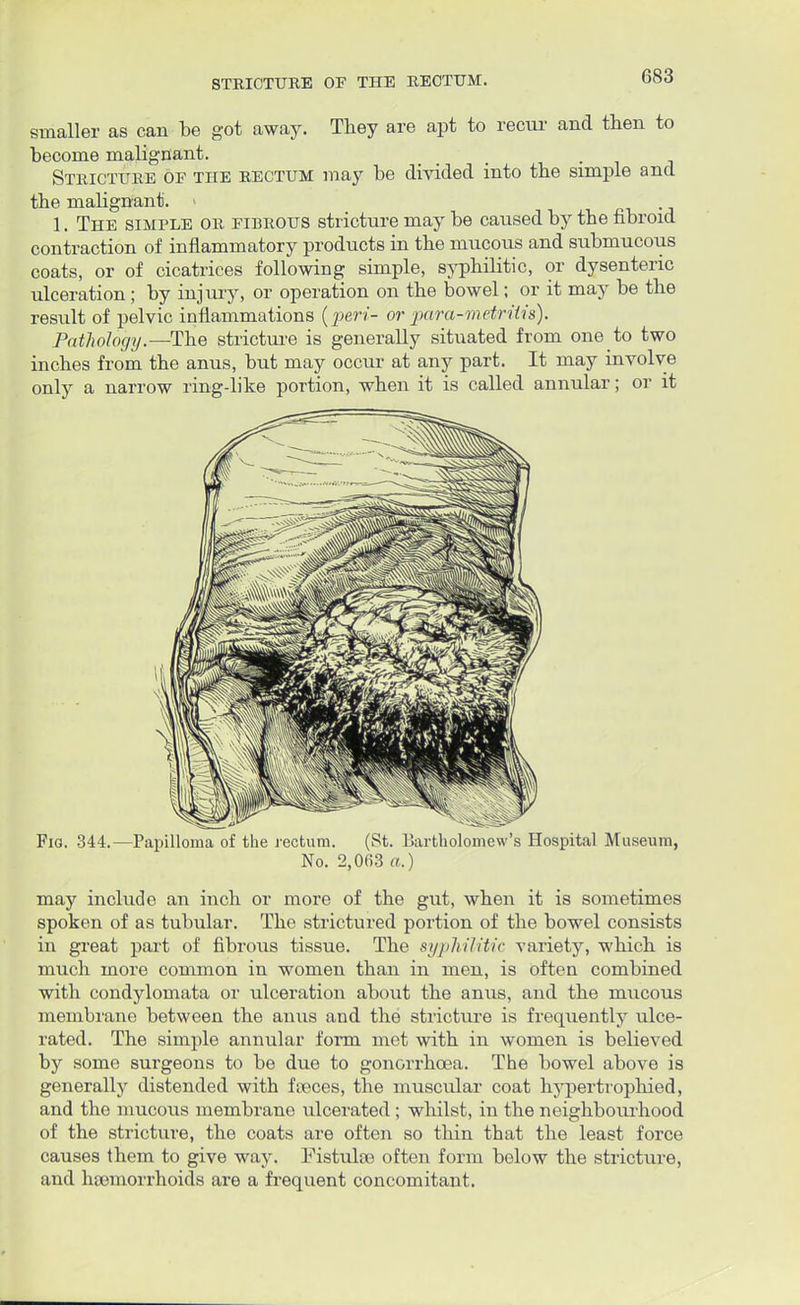 STRICTURE OF THE RECTUM. smaller as can be got away. They are apt to recur and then to become malignant. • . Stricture or the rectum may be divided into the simple and the malignant. - 1. The simple or fibrous stricture may be caused by the fibroid contraction of inflammatory products in the mucous and submucous coats, or of cicatrices following simple, syphilitic, or dysenteric ulceration; by injury, or operation on the bowel; or it may be the result of pelvic inflammations {peri- or para-metriiis). Pathology—-The stricture is generally situated from one to two inches from the anus, but may occur at any part. It may involve only a narrow ring-like portion, when it is called annular; or it Fig. 344.—Papilloma of the rectum. (St. Bartholomew's Hospital Museum, No. 2,063 a.) may include an inch or more of the gut, when it is sometimes spoken of as tubular. The strictured portion of the bowel consists in great part of fibrous tissue. The syphilitic variety, which is much more common in women than in men, is often combined with condylomata or ulceration about the anus, and the mucous membrane between the anus and the stricture is frequently ulce- rated. The simple annular form met with in women is believed by some surgeons to be due to gonorrhoea. The bowel above is generally distended with freces, the muscular coat hypertrophied, and the mucous membrane ulcerated ; whilst, in the neighbourhood of the stricture, the coats are often so thin that the least force causes them to give way. Fistulas often form below the stricture, and haemorrhoids are a frequent concomitant.