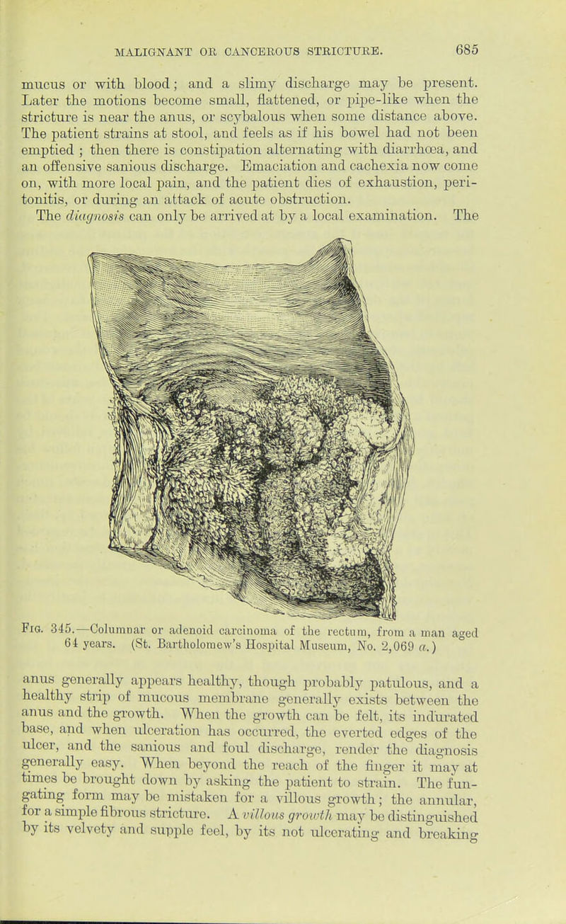 mucus or with blood; and a slimy discharge may be present. Later the motions become small, flattened, or pipe-like when the stricture is near the anus, or scybalous when some distance above. The patient strains at stool, and feels as if his bowel had not been emptied ; then there is constipation alternating with diarrhoea, and an offensive sanious discharge. Emaciation and cachexia now come on, with more local pain, and the patient dies of exhaustion, peri- tonitis, or during an attack of acute obstruction. The diagnosis can only be arrived at by a local examination. The Fig. 345.—Columnar or adenoid carcinoma of the rectum, from a man aged 64 years. (St. Bartholomew's Hospital Museum, No. 2,069 a.) anus generally appears healthy, though probably patulous, and a healthy strip of mucous membrane generally exists between the anus and the growth. When the growth can lie felt, its indurated base, and when ulceration has occurred, the everted edges of the ulcer, and the sanious and foul discharge, render the diagnosis generally easy. When beyond the reach of the finger it may at times be brought down by asking the patient to strain. The fun- gating form maybe mistaken for a villous growth; the annular, for a simple fibrous stricture. A villous growth may be distinguished by its velvety and supple feel, by its not ulcerating and breaking