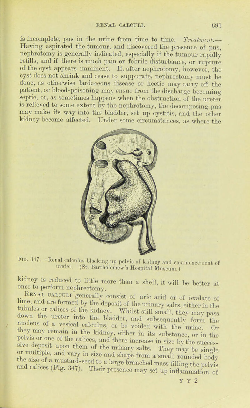 is incomplete, pus in the urine from time to time. Treatment.— Having aspirated the tumour, and discovered the presence of pus, nephrotomy is generally indicated, especially if the tumour rapidly refills, and if there is much pain or febrile disturbance, or rupture of the cyst appears imminent. If, after nephrotomy, however, the cyst does not shrink and cease to suppurate, nephrectomy must be done, as otherwise lardaceous disease or hectic may carry off the patient, or blood-poisoning may ensue from the discharge becoming septic, or, as sometimes happens when the obstruction of the ureter is relieved to some extent by the nephrotomy, the decomposing pus may make its way into the bladder, set up'cystitis, and the other kidney become affected. Under some circumstances, as where the Fm. 347.-Renal calculus blocking up pelvis of kidney and commencement of ureter. (St. Bartholomew's Hospital Museum.) kidney is reduced to little more than a shell, it will be better at once to perform nephrectomy. Eenal calculi generally consist of uric acid or of oxalate of lime and are formed by the deposit of the urinary salts, either in the tubules or cahces of the kidney. Whilst still small, they may pass down the ureter into the bladder, and subsequently^ form the nucleus of a vesical calculus, or be voided with the urine Or tl-y may remain m the kidney, either in its substance, or in the pelvis or one of the calices, and there increase in size by the succes! sive deposit upon them of the urinary salts. They mly be Sle or multip e, and vary m size and shape from a small rounded body the size of a mustard-seed to a large branched mass filling the pelvis and cahces (Pig. 347). Their presence may set up inflammation ol Y Y 2