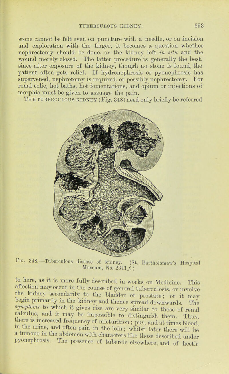 stone cannot be felt even on puncture with, a needle, or on incision and exploration with the finger, it becomes a question whether nephrectomy should be done, or the kidney left in situ, and the wound merely closed. The latter procedure is generally the best, since after exposure of the kidney, though no stone is found, the patient often gets relief. If hydronephrosis or pyonephrosis has supervened, nephrotomy is required, or possibly nephrectomy. For renal colic, hot baths, hot fomentations, and opium or injections of morphia must be given to assuage the pain. The tuberculous kidney (Pig. 34S) need only briefly be referred Fig. 348.—Tuberculous disease of kidney. (St. Bartholomew's Hospital Museum, No. 2311 /.) to here, as it is more fully described in works on Medicine. This affection may occur in the course of general tuberculosis, or involve the kidney secondarily to the bladder or prostate; or it may begin primarily m the kidney and thence spread downwards. The symptoms to which it gives rise are very similar to those of renal calculus, and it may be impossible to distinguish them. Thus there is increased frequency of micturition; pus, and at times blood, m the urine, and often pain in the loin ; whilst later there will be a tumour m the abdomen with characters like those described under pyonephrosis. The presence of tubercle elsewhere, and of hectic