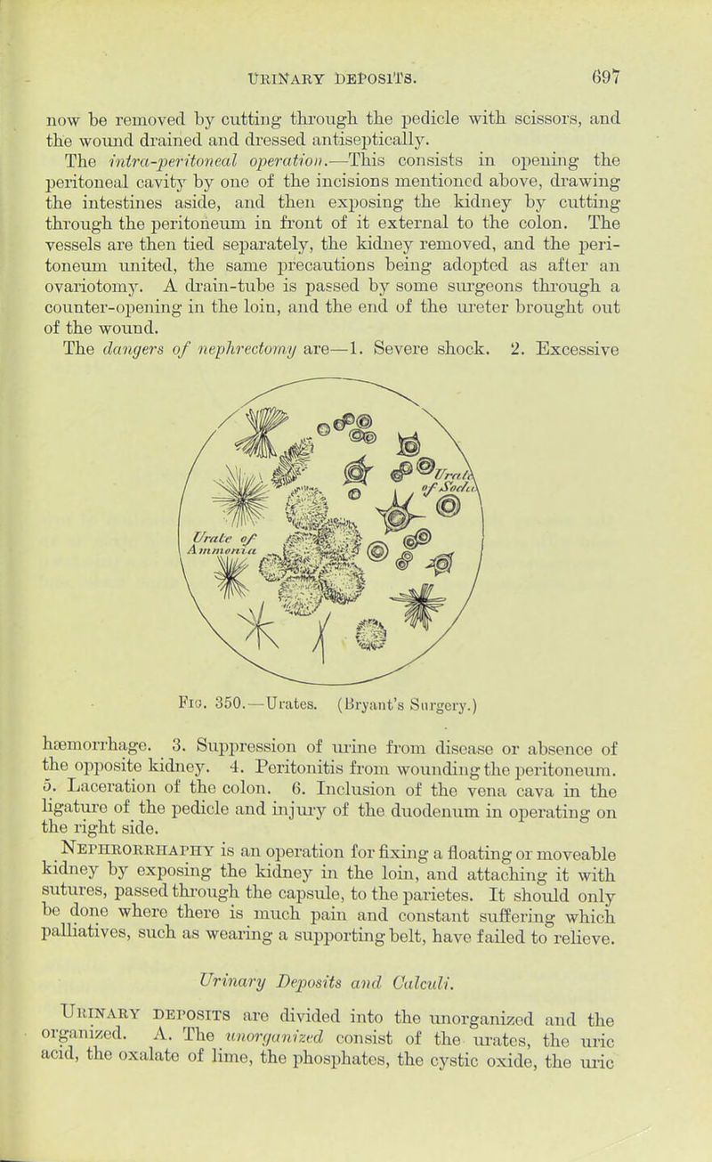 now be removed by cutting through the pedicle with scissors, and the wound drained and dressed antiseptieally. The inira-peritoneal operation.—This consists in opening the peritoneal cavity by one of the incisions mentioned above, drawing the intestines aside, and then exposing the kidney by cutting through the peritoneum in front of it external to the colon. The vessels are then tied separately, the kidney removed, and the peri- toneum united, the same precautions being adopted as after an ovariotomy. A drain-tube is passed by some surgeons through a counter-opening in the loin, and the end of the ureter brought out of the wound. The dangers of nephrectomy are—1. Severe shock. 2. Excessive Fio. 350.—Urates. (Bryant's Surgery.) haemorrhage. 3. Suppression of urine from disease or absence of the opposite kidney. 4. Peritonitis from wounding the peritoneum. 5. Laceration of the colon. 6. Inclusion of the vena cava in the ligature of the pedicle and injury of the duodenum in operating on the right side. Nephrorriiaphy is an operation for fixing a floating or moveable kidney by exposing the kidney in the loin, and attaching it with sutures, passed through the capsule, to the parietes. It should only be done where there is much pain and constant suffering which palliatives, such as wearing a supporting belt, have failed to relieve. Urinary Deposits and Calculi. Urinary deposits are divided into the unorganized and the organized. A. The unorganized consist of the urates, the uric acid, the oxalate of lime, the phosphates, the cystic oxide, the uric