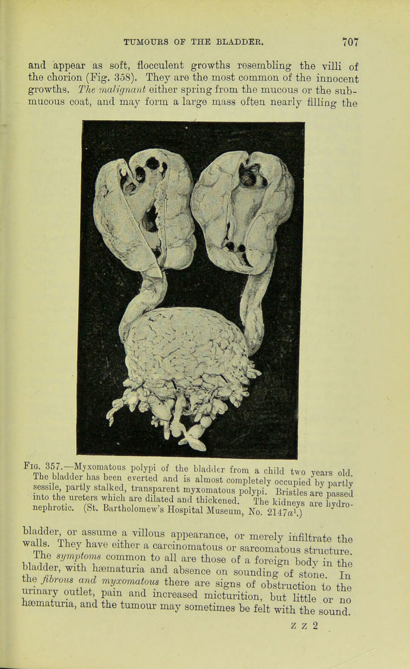 and appear as soft, flocculent growths resembling the villi of the chorion (Fig. 358). They are the most common of the innocent growths. The malignant either spring from the mucous or the sub- mucous coat, and may form a large mass often nearly filling the Fl5^^--Myxomatous polypi of the bladder from a child two years old The bladder has been everted and is almost completely occupied by parly sessile part y stalked, transparent myxomatous polypi. Bris les are mssed into the ureters which are dilated and thickened. The kidneys are hvdrn nephrotic. (St. Bartholomew's Hospital Museum, No. 2147«> ) J bladder or assume a.villous appearance, or merely infiltrate the walls, rhey have either a carcinomatous or sarcomatous structure The symptoms common to all are those of a foreign body in the bladder, with hematuria and absence on sounding of stone In the fibrou* and myxomatous there are signs of obstruction to the urinary outlet pam and increased micturition, but little or no hematuria, and the tumour- may sometimes be felt with the sound Z z 2