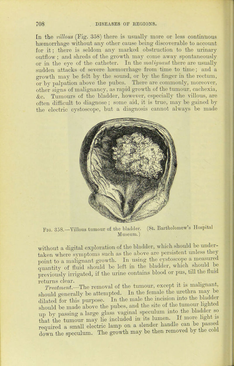 En the villous (Fig. 358) there is usually more or less continuous haemorrhage without any other cause being discoverable to account for it; there is seldom any marked obstruction to the urinary outflow; and shreds of the growth may como away spontaneously or in the eye of the catheter. In the malignant there are usually sudden attacks of severe haemorrhage from time to time; and a growth may be felt by the sound, or by the finger in the rectum, or by palpation above the pubes. There are commonly, moreover, other signs of malignancy, as rapid growth of the tumour, cachexia, &c. Tumours of the bladder, however, especially the villous, are often difficult to diagnose ; some aid, it is true, may be gained by the electric cystoscope, but a diagnosis cannot always be made Fia. 358.—Villous tumour of the bladder. (St. Bartholomew's Hospital Museum.) without a digital exploration of the bladder, which should be under- taken where symptoms such as the above are persistent unless they point to a malignant growth. In using the cystoscope a measured quantity of fluid should be left in the bladder, which should be previously irrigated, if the urine contains blood or pus, till the fluid returns clear. ■ .. , Treatment.—The removal of the tumour, except it is malignant, should generally be attempted. In the female the urethra may be dilated for this purpose. In the male the incision into the bladder should be made above the pubes, and the site of the tumour lighted up by passing a large glass vaginal speculum into the bladder so that the tumour may lie included in its lumen. If more bght is required a small electric lamp on a slender handle can be passed down the speculum. The growth may be then removed by the cold