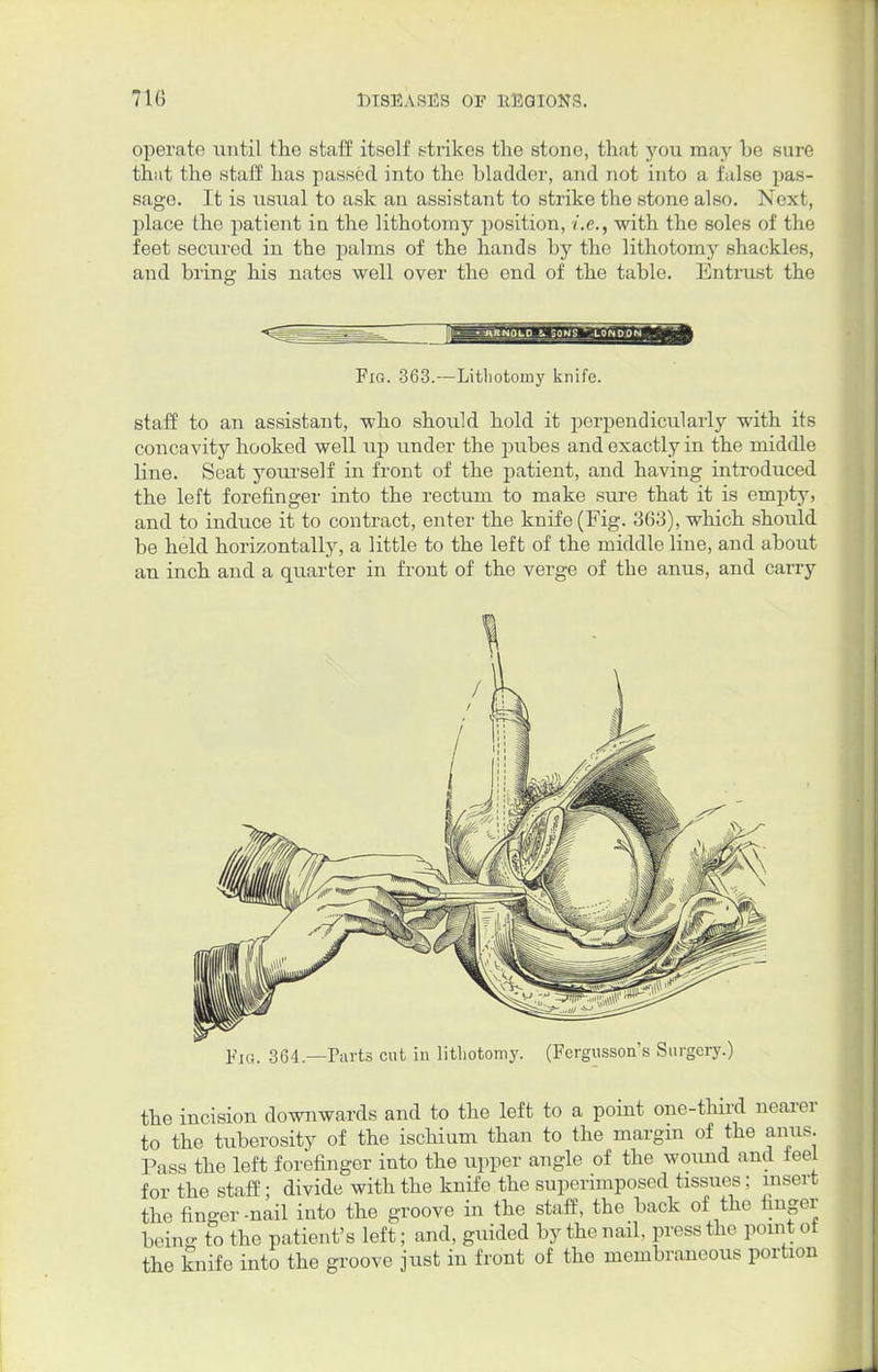 operate until the staff itself .strikes the stone, that you may he sure that the staff has passed into the Madder, and not into a false pas- sage. It is usual to ask an assistant to strike the stone also. Next, place the patient in the lithotomy position, i.e., with the soles of the feet secured in the palms of the hands hy the lithotomy shackles, and bring his nates well over the end of the table. Entrust the Fig. 363.—Lithotomy knife. staff to an assistant, who should hold it perpendicularly with its concavity hooked well up under the pubes and exactly in the middle line. Seat yourself in front of the patient, and having introduced the left forefinger into the rectum to make sure that it is empty, and to induce it to contract, enter the knife (Fig. 363), which should be held horizontally, a little to the left of the middle line, and about an inch and a quarter in front of the verge of the anus, and carry the incision downwards and to the left to a point one-third nearer to the tuberosity of the ischium than to the margin of the anus. Pass the left forefinger into the upper angle of the wound and ieel for the staff; divide with the knife the superimposed tissues; insert the finder-nail into the groove in the staff, the back of the finger being to the patient's left; and, guided by the nail, press the point of the knife into the groove just in front of the membraneous portion