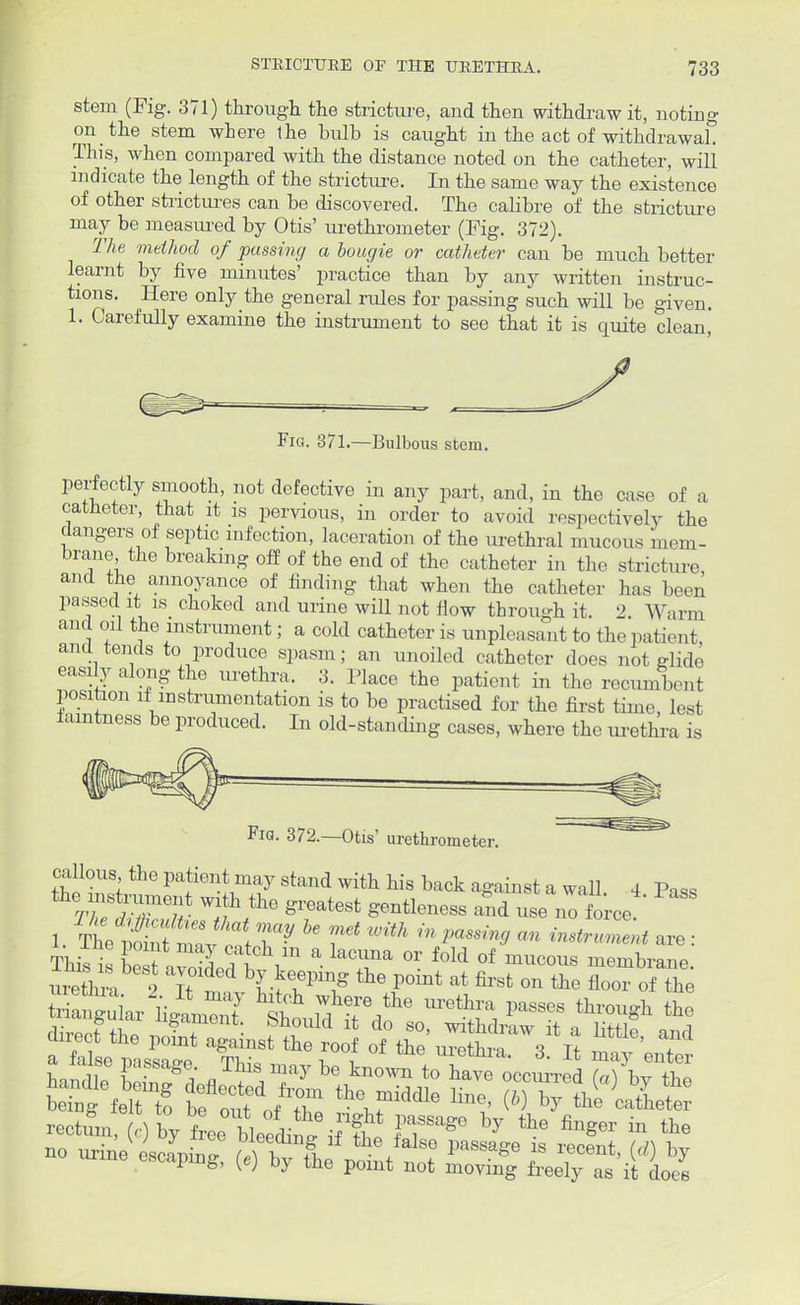 stem (Fig. 371) through the stricture, and then withdraw it, noting on the stem where the bulb is caught in the act of withdrawal. This, when compared with the distance noted on the catheter, will indicate the length of the stricture. In the same way the existence of other strictures can be discovered. The calibre of the stricture may be measured by Otis' urethrometer (Fig. 372). The method of pussing a bougie or catheter can be much better learnt by five minutes' practice than by any written instruc- tions. Here only the general rules for passing such will be given. 1. Carefully examine the instrument to see that it is quite clean, Fig. 371.—Bulbous stem. perfectly smooth, not defective in any part, and, in the case of a catheter, that it is pervious, in order to avoid respectively the clangers of septic infection, laceration of the urethral mucous mem- brane the breaking off of the end of the catheter in the stricture and the annoyance of finding that when the catheter has been passed it is_ choked and urine will not flow through it. 2. Warm and oil the instrument; a cold catheter is unpleasant to the patient, and tends to produce spasm; an unoiled catheter does not Hide easily along the urethra. 3. Place the patient in the recumbent position if instrumentation is to be practised for the first time, lest famtness be produced. In old-standing cases, where the urethra is FlG. 372.—Otis' urethrometer. callous the patient may stand with his back against a wall. 4 Pass TtedJTt Wf!he greatest S'entleness ™d ™ no force This Savdi^V11 a laTa °r f0W °f mucous ^mbrane. uX 2 Tt {•hepillg the P°lnt at firsfc on the floor of the no urine escaninT M >.ft the *alse Passage is recent, (d) by mine escaping, (e) by the point not moving freely as it does