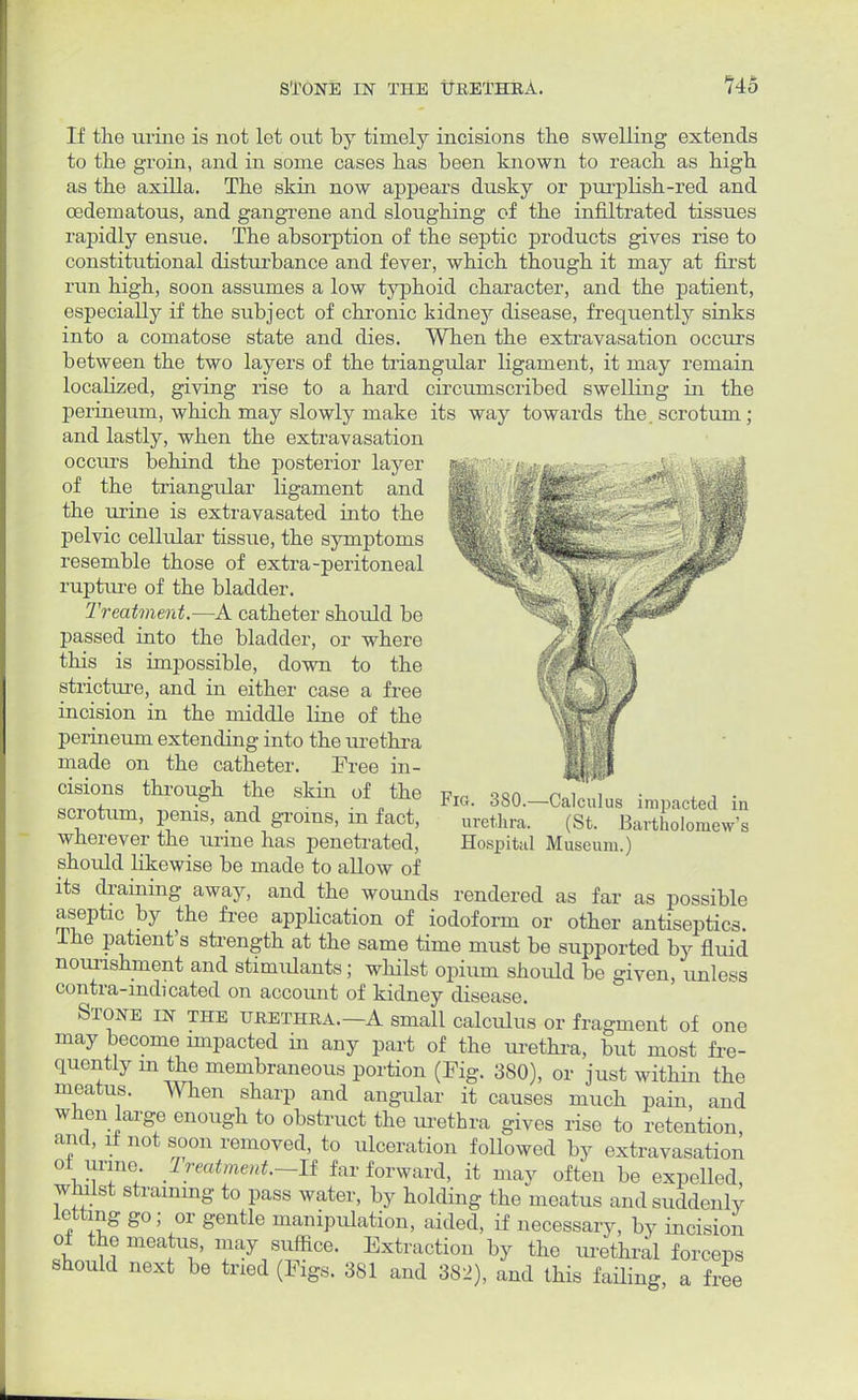STONE IN THE URETHRA. 146 If the urine is not let out by timely incisions the swelling extends to the groin, and in some cases has been known to reach as high as the axilla. The skin now appears dusky or purplish-red and cedematous, and gangrene and sloughing of the infiltrated tissues rapidly ensue. The absorption of the septic products gives rise to constitutional disturbance and fever, which though it may at first run high, soon assumes a low typhoid character, and the patient, especially if the subject of chronic kidney disease, frequently sinks into a comatose state and dies. When the extravasation occurs between the two layers of the triangular ligament, it may remain localized, giving rise to a hard circumscribed swelling in the perineum, which may slowly make its way towards the. scrotum; and lastly, when the extravasation occurs behind the posterior layer WM^^'MSu < of the triangular ligament and 'M *> the urine is oxtruvasated into the W.Mmi&k pelvic cellular tissue, the symptoms resemble those of extra-peritoneal rupture of the bladder. Treatment.—A catheter should be passed into the bladder, or where this is impossible, down to the stricture, and in either case a free incision in the middle line of the perineum extending into the urethra made on the catheter. Free in- cisions through the skin of the scrotum, penis, and groins, in fact, wherever the urine has penetrated, should likewise be made to allow of its draining away, and the wounds rendered as far as possible aseptic by the free application of iodoform or other antiseptics. Ihe patient's strength at the same time must be supported by fluid nourishment and stimulants; whilst opium should be given, unless contra-indicated on account of kidney disease. Stone in the urethra.—A small calculus or fragment of one may become impacted in any part of the urethra, but most fre- quently m the membraneous portion (Fig. 380), or just within the meatus. When sharp and angular it causes much pain, and when large enough to obstruct the urethra gives rise to retention and, it not soon removed, to ulceration foUowed by extravasation ot urine Treatmmt.-B far forward, it may often be expelled, whilst straining to pass water, by holding the meatus and suddenly letting go; or gentle manipulation, aided, if necessary, by incision of the meatus, may suffice. Extraction by the urethral forceps should next be tried (Figs. 381 and 382), and this failing, a free Fig. 380.—Calculus impacted in urethra. (St. Bartholomew's Hospital Museum.)