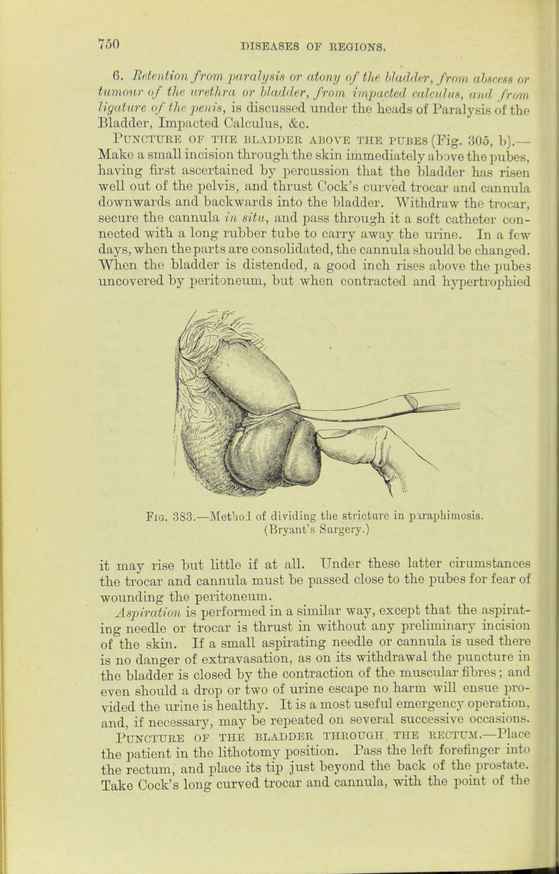 6. Retention front paralysis or atony of the bladder, from abscess or tumour of the urethra or bladder, from impacted calculus, ami from ligature of the pen is, is discussed under the heads of Paralysis of the Bladder, Impacted Calculus, &c. Puncture of the bladder above the pubes (Fig. 305, b).— Make a small incision through the skin immediately above the pubes. Inning first ascertained by percussion that the bladder has risen well out of the pelvis, and thrust Cock's curved trocar and cannula downwards and backwards into the bladder. Withdraw the trocar; secure the cannula in situ, and pass through it a soft catheter con- nected with a long rubber tube to carry away the urine. In a £ w days, when the parts are consolidated, the cannula should be chang< sd. When the bladder is distended, a good inch rises above the pubes uncovered by peritoneum, but when contracted and hypertrophied Fig. 3S3.—Method of dividing the stricture in paraphimosis. (Bryant's Surgery.) it may rise but little if at all. Under these latter cirurnstances the trocar and cannula must be passed close to the pubes for fear of wounding the peritoneum. Aspiration is performed in a similar way, except that the aspirat- ing needle or trocar is thrust in without any preliminary incision of the skin. If a small aspirating needle or cannula is used there is no danger of extravasation, as on its withdrawal the puncture in the bladder is closed by the contraction of the muscular fibres; and even should a drop or two of urine escape no harm will ensue pro- vided the urine is healthy. It is a most useful emergency operation, and, if necessary, may be repeated on several successive occasions. Puncture of the bladder through the rectum,—Place the patient in the lithotomy position. Pass the left forefinger into the rectum, and place its tip just beyond the back of the prostate. Take Cock's long curved trocar and cannula, with the point of the