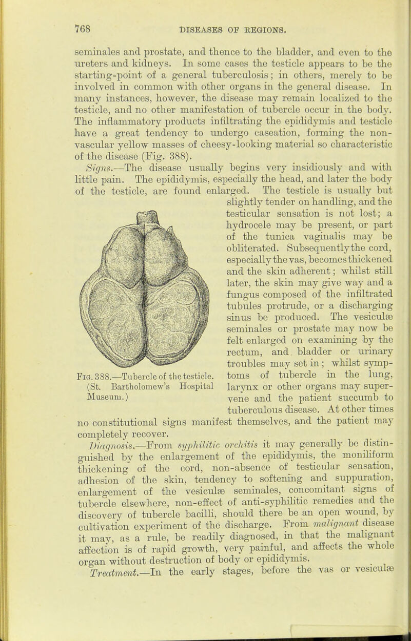 seminales and prostate, and thence to the bladder, and even to the ureters and kidneys. In some cases the testicle appears to be the starting-point of a general tuberculosis; in others, merely to be involved in common with other organs in the genera] disease. In many instances, however, the disease may remain localized to the testicle, and no other manifestation of tubercle occur in the body. The inflammatory products infiltrating the epididymis and testicle have a great tendency to undergo caseation, forming the non- vascular yellow masses of cheesy-looking material so characteristic of the disease (Fig. 388). Signs.—The disease usually begins very insidiously and with little pain. The epididymis, especially the head, and later the body of the testicle, are found enlarged. The testicle is usually but slightly tender on handling, and the testicular sensation is not lost; a hydrocele may be present, or part of the tunica vaginalis may be obliterated. Subsequently the cord, especially the vas, becomes thickened and the skin adherent; whilst still later, the skin may give way and a fungus composed of the infiltrated tubules protrude, or a discharging sinus be produced. The vesiculse seminales or prostate may now be felt enlarged on examining by the rectum, and bladder or urinary troubles may set in; whilst symp- Fig.388.—Tubercle of the testicle, toms of tubercle in the lung, (St. Bartholomew's Hospital larynx or other organs may super- Museum.) vene and the patient succumb to tuberculous disease. At other times no constitutional signs manifest themselves, and the patient may completely recover. Diagnosis,—From syphilitic orchitis it may generally be distin- guished by the enlargement of the epididymis, the moniliform thickening of the cord, non-absence of testicular sensation, adhesion of the skin, tendency to softening and suppuration, enlargement of the vesiculse seminales, concomitant signs of tubercle elsewhere, non-effect of anti-syphilitic remedies and the discovery of tubercle bacilli, should there be an open wound, by cultivation experiment of the discharge. From malignant disease it may, as a rule, be readily diagnosed, in that the malignant affection is of rapid growth, very painful, and affects the whole organ without destruction of body or epididymis. Treatment.—-In the early stages, before the vas or vesiculse