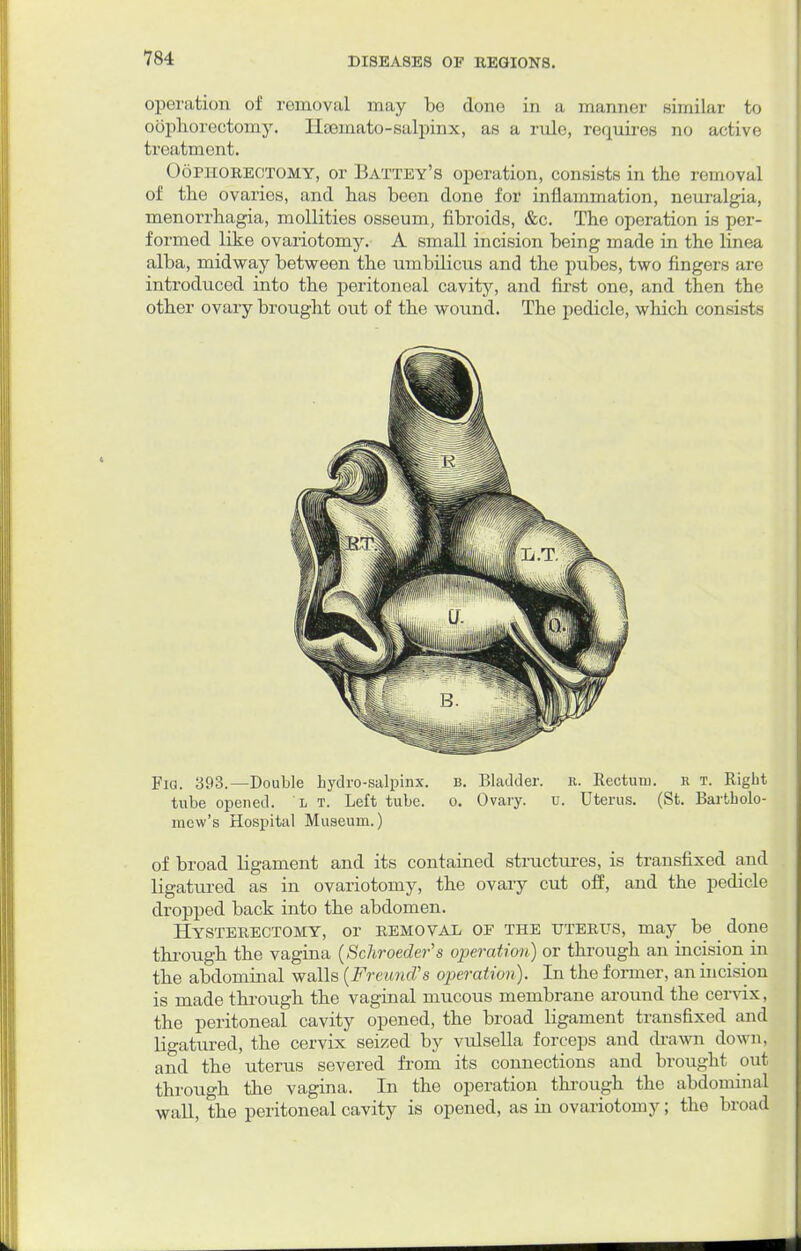 operation of removal may bo done in a manner similar to oophorectomy. Haemato-salpinx, as a rule, requires no active treatment. Oophorectomy, or Battey's operation, consists in the removal of the ovaries, and has been done for inflammation, neuralgia, monorrhagia, mollities osseum, fibroids, &c. The operation is per- formed like ovariotomy. A small incision being made in the linea alba, midway between the umbilicus and the pubes, two fingers are introduced into the peritoneal cavity, and first one, and then the other ovary brought out of the wound. The pedicle, which consists Fig. 393.—Double hydro-salpinx. b. Bladder, r. Rectum, r t. Right tube opened. l t. Left tube. o. Ovary. u. Uterus. (St. Bartholo- mew's Hospital Museum.) of broad ligament and its contained structru-es, is transfixed and ligatured as in ovariotomy, the ovary cut off, and the pedicle dropped back into the abdomen. Hysterectomy, or removal of the uterus, may be done through the vagina (Schroeder's operation) or through an incision in the abdominal walls (Freuncfs operation). In the former, an incision is made through the vaginal mucous membrane around the cervix, the peritoneal cavity opened, the broad ligament transfixed and ligatured, the cervix seized by vulsella forceps and drawn down, and the uterus severed from its connections and brought out through the vagina. In the operation through the abdominal wall, the peritoneal cavity is opened, as in ovariotomy; the broad