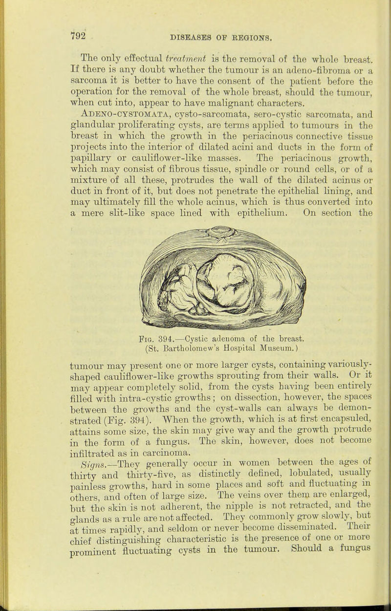 The only effectual treatment is the removal of the whole breast. If there is any doubt whether the tumour is an adeno-fibroma or a sarcoma it is better to have the consent of the patient before the operation for the removal of the whole breast, should the tumour, when cut into, appear to have malignant characters. Adeno-cystomata, cysto-sarcomata, sero-cystic sarcomata, and glandular proliferating cysts, are terms applied to tumours in the breast in which the growth in the periacinous connective tissue projects into the interior of dilated acini and ducts in the form of papillary or cauliflower-like masses. The periacinous growth, which may consist of fibrous tissue, spindle or round cells, or of a mixture of all these, protrudes the wall of the dilated acinus or duct in front of it, but does not penetrate the epithelial lining, and may ultimately fill the whole acinus, which is thus converted into a mere slit-like space lined with epithelium. On section the Fig. 394.—Cystic adenoma of the breast. (St. Bartholomew's Hospital Museum.) tumour may present one or more larger cysts, containing variously- shaped cauliflower-like growths sprouting from their walls. Or it may appear completely solid, from the cysts having been entirely filled with intra-cystic growths; on dissection, however, the spaces between the growths and the cyst-walls can always be demon- strated (Fig. 394). When the growth, which is at first encapsuled, attains some size, the skin may give way and the growth protrude in the form of a fungus. The skin, however, does not become infiltrated as in carcinoma. Signs. They generally occur in women between the ages of thirty and thirty-five, as distinctly defined, lobulated, usually painless growths, hard in some places and soft and fluctuating in others, and often of large size. The veins over them are enlarged, but the skin is not adherent, the nipple is not retracted, and the glands as a rule are not affected. They commonly grow slowly, but at times rapidly, and seldom or never become disseminated. Their chief distinguishing characteristic is the presence of one or more prominent fluctuating cysts in the tumour. Should a fungus