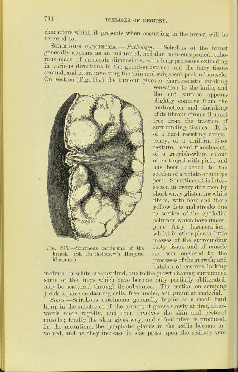 characters which it presents when occurring in the hreast will be rol'erred to. Scirrhous carcinoma. — Pathology, — Scirrhus of the breast generally appears as an indurated, nodular, non-encapsuled, tube- rous mass, of moderate dimensions, with long processes extending m various directions in the gland-substance and the fatty tissue around, and later, involving the skin and subjacent pectoral muscle. On section (Fig. 395) the tumour gives a characteristic creaking sensation to the knife, and the cut surface appears slightly concave from the contraction and shrinking of its fibrous stroma thus set free from the traction of surrounding tissues. It is of a hard resisting consis- tency, of a uniform close texture, semi-translucent, of a greyish-white colour often tinged with pink, and has been likened to the section of a potato or unripe pear. Sometimes it is inter- sected in every direction by short wavy glistening white fibres, with here and there yellow dots and streaks due to section of the epithelial columns which have under- gone fatty degeneration ; whilst in other places, little masses of the suiTounding fatty tissue and of muscle are seen enclosed by the processes of the growth; and patches of caseous-looking material or white creamy fluid, due to the growth having surrounded some of the ducts which have become only partially obHterated, may be scattered through its substance. The section on scraping yields a juice containing cells, free nuclei, and granular material. Xii/ns.—Scirrhous carcinoma generally begins as a small hard lump in the substance of the breast; it grows slowly at first, after- wards more rapidly, and then involves the skin and pectoral muscle; finally the skin gives way, and a foul ulcer is produced. In the meantime, the lymphatic glands in the axilla become in- volved, and as they increase in size press upon the axillary vein Fig. 395.—Scirrhous carcinoma of the breast. (St. Bartholomew's Hospital Museum.)