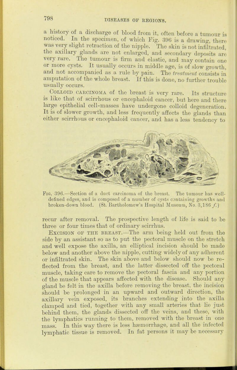 a history of a discharge of blood from it, often before a tumour is noticed. In the specimen, of which Pig. 39(5 is a drawing, there was very slight retraction of the nipple. The skin is not infiltrated, the axillary glands are not enlarged, and secondary deposits are very rare. The tumour is firm and elastic, and may contain one or more cysts. It usually occurs in middle age, is of slow growth, and not accompanied as a rule by pain. The treatment consists in amputation of the whole breast. If this is done, no further trouble usually occurs. Colloid carcinoma of the breast is very rare. Its structure is like that of scirrhous or encephaloid cancer, but here and there large epithelial cell-masses have undergone colloid degeneration. It is of slower growth, and less frequently affects the glands than either scirrhous or encephaloid cancer, and has a less tendency to Fig. 396.—Section of a duct carcinoma of the breast. The tumour has well- defined edges, and is composed of a number of cysts containing growths and broken-down blood. (St. Bartholomew's Hospital Museum, No. 3,186 f.) recur after removal. The prospective length of life is said to be three or four times that of ordinary scirrhus. Excision of the breast.—The arm being held out from the side by an assistant so as to put the pectoral muscle on the stretch and well expose the axilla, an elliptical incision should be made below and another above the nipple, cutting widely of any adherent or infiltrated skin. The skin above and below should now be re- flected from the breast, and the latter dissected off the pectoral muscle, taking care to remove the pectoral fascia and any portion of the muscle that appears affected with the disease. Should any gland be felt in the axilla before removing the breast, the incision should be prolonged in an upward and outward direction, the axillary vein exposed, its branches extending into the axilla clamped and tied, together with any small arteries that lie just behind them, the glands dissected off the veins, and these, with the lymphatics running to them, removed with the breast in one mass. In this way there is less haemorrhage, and all the infected lymphatic tissue is removed. In fat persons it may be necessary