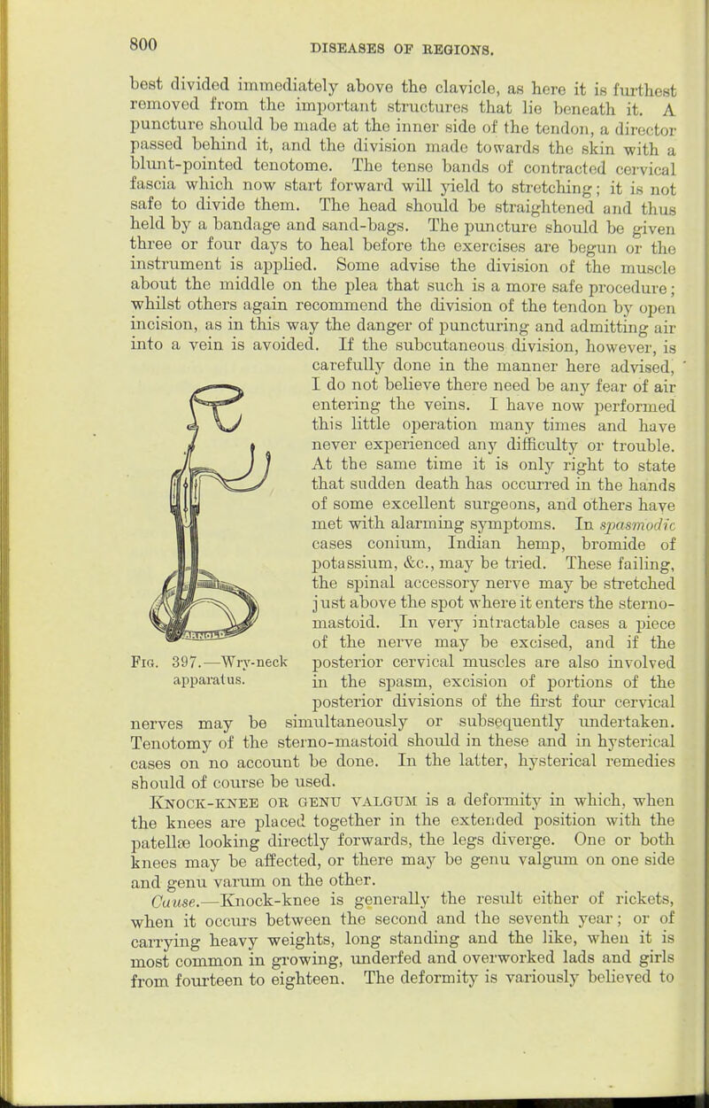 best divided immediately above tbe clavicle, as here it is furthest removed from the important structures that lie beneath it. A puncture should be made at the inner side of the tendon, a director passed behind it, and the division made towards the skin with a blunt-pointed tenotome. The tense bands of contracted cervical fascia which now start forward will yield to stretching; it is noj safe to divide them. The head should be straightened and thus held by a bandage and sand-bags. The puncture should be given three or four days to heal before the exercises are begun or the instrument is applied. Some advise the division of the muscle about the middle on the plea that such is a more safe procedure; whilst others again recommend the division of the tendon by open incision, as in this way the danger of puncturing and admitting air into a vein is avoided. If the subcutaneous division, however, is carefully done in the manner here advised, I do not believe there need be any fear of air entering the veins. I have now performed this little operation many times and have never experienced any difficulty or trouble. At the same time it is only right to state that sudden death has occurred in the hands of some excellent surgeons, and others have met with alarming symptoms. In sjpbsm'Qclu cases conium, Indian hemp, bromide of potassium, &c, may be tried. These failing, the spinal accessory nerve may be stretched just above the spot where it enters the sterno- mastoid. In very intractable cases a piece of the nerve may be excised, and if the Fig. 397.—Wry-neck posterior cervical muscles are also involved apparatus. ^ the spasm, excision of portions of the posterior divisions of the first four cervical nerves may be simultaneously or subsequently undertaken. Tenotomy of the sterno-mastoid should in these and in hysterical cases on no account be done. In the latter, hysterical remedies should of course be used. Knock-knee or genu valgum is a deformity in which, when the knees are placed together in the extended position with the patellte looking directly forwards, the legs diverge. One or both knees may be affected, or there may be genu valgum on one side and genu varum on the other. Cause.—Knock-knee is generally the result either of rickets, when it occurs between the second and the seventh year; or of carrying heavy weights, long standing and the like, when it is most common in growing, underfed and overworked lads and girls from fourteen to eighteen. The deformity is variously believed to