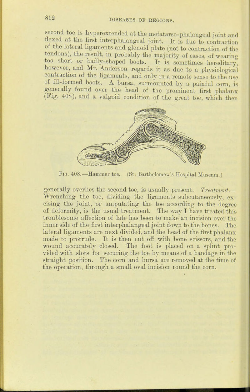 second too is hyperextondcd at the metatarsophalangeal joint and flexed at tho first interphalangeal joint. It is due to contraction ol the lateral ligaments and glenoid plate (not to contraction of the tendons), the result, in probably the majority of cases, of wearing too short or badly-shaped boots. It is sometimes hereditary, however, and Mr. Anderson regards it as due to a physiological contraction of the ligaments, and only in a remote sense to the use of ill-formed boots. A bursa, surmounted by a painful corn, is generally found over the head of the prominent first phalanx (Fig. 408), and a valgoid condition of the great toe, which thou Fig. 408.—Hammer toe. (St. Bartholomew's Hospital Museum.) generally overlies the second toe, is usually present. Treatment.— Wrenching the toe, dividing the ligaments subcutaneously, ex- cising the joint, or amputating the toe according to the degree of deformity, is the usual treatment. The way I have treated this troublesome affection of late has been to make an incision over the inner side of the first interphalangeal joint down to the bones. The lateral ligaments are next divided, and the head of the first phalanx made to protrude. It is then cut off with bone scissors, and the wound accurately closed. The foot is placed on a splint pro- vided with slots for securing the toe by means of a bandage in the straight position. The corn and bursa are removed at the time of the operation, through a small oval incision round the corn.