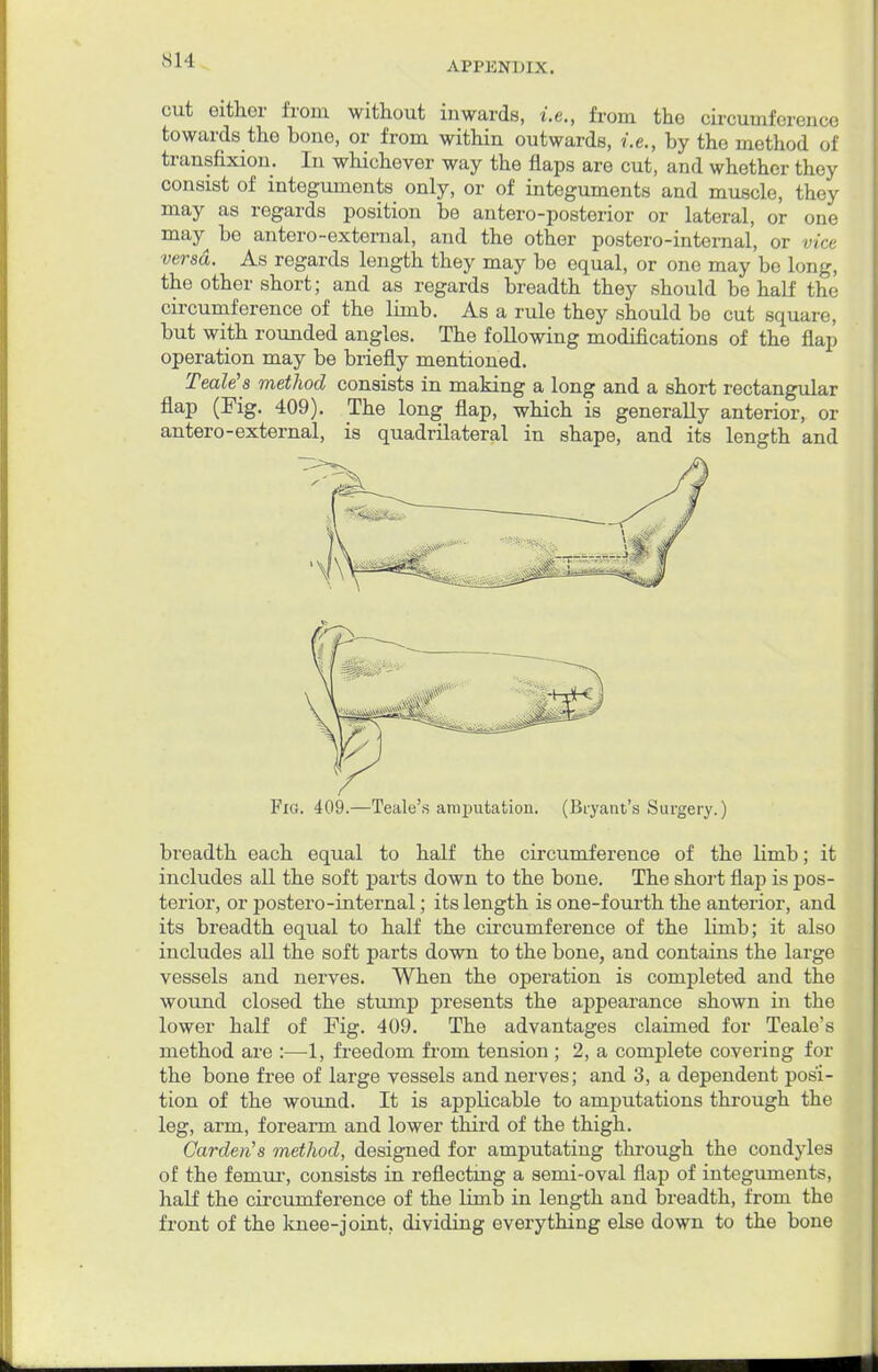 APPKN1UX. cut either from without inwards, i.e., from the circumference towards the bone, or from within outwards, i.e., by the method of transfixion. In whichever way the flaps are cut, and whether they consist of integuments only, or of integuments and muscle, they may as regards position be antero-posterior or lateral, or one may be antero-external, and the other postero-internal, or vice versa. As regards length they may be equal, or one may be long, the other short; and as regards breadth they should be half the circumference of the limb. As a rule they should bo cut square, but with rounded angles. The following modifications of the flap operation may be briefly mentioned. Teale's method consists in making a long and a short rectangular flap (Fig. 409). The long flap, which is generally anterior, or antero-external, is quadrilateral in shape, and its length and breadth each equal to half the circumference of the limb; it includes all the soft parts down to the bone. The short flap is pos- terior, or postero-internal; its length is one-fourth the anterior, and its breadth equal to half the circumference of the limb; it also includes all the soft parts down to the bone, and contains the large vessels and nerves. When the operation is completed and the wound closed the stump presents the appearance shown in the lower half of Fig. 409. The advantages claimed for Teale's method are :—1, freedom from tension ; 2, a complete covering for the bone free of large vessels and nerves; and 3, a dependent posi- tion of the wound. It is applicable to amputations through the leg, arm, foreann and lower third of the thigh. Garden's method, designed for amputating through the condyles of the femur, consists in reflecting a semi-oval flap of integuments, half the circumference of the limb in length and breadth, from the front of the knee-joint, dividing everything else down to the bone Fig. 409.—Teale's amputation. (Bryant's Surgery.)