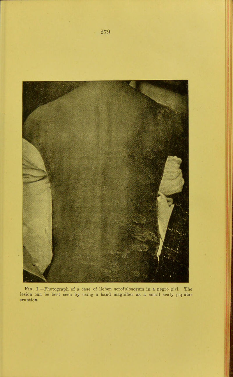 Fig. I.—Photograph of a case of lichen scrofulosorum in a negro girl. The lesion can be best seen by using a hand magnifier as a small scaly papular eruption.