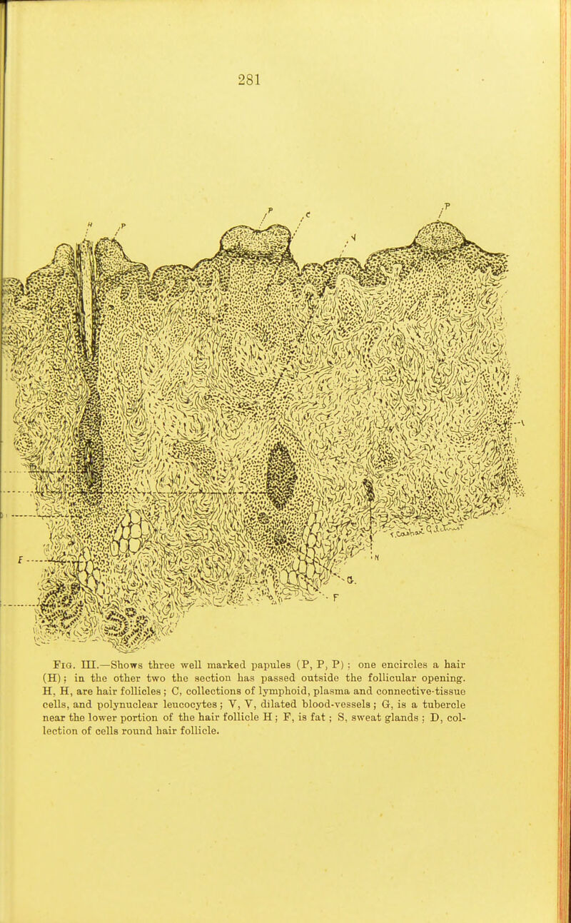 Fig. III.—Shows three well marked papules (P, P, P) : one encircles a hair (H); in the other two the section has passed outside the follicular opening. H, H, are hair follicles ; C, collections of lymphoid, plasma and connective-tissue cells, and polynuclear leucocytes; V, V, dilated blood-vessels; G, is a tubercle near the lower portion of the hair follicle H ; F, is fat ; S, sweat glands ; D, col- lection of cells round hair follicle.