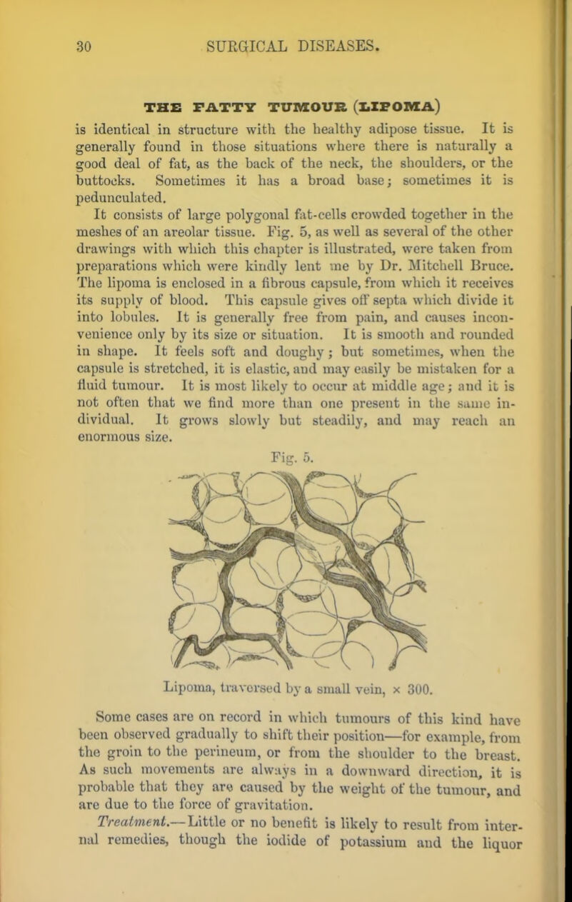 THE PATTY TUMOUR (LIPOMA) is identical in structure with the healthy adipose tissue. It is generally found in those situations where there is naturally a good deal of fat, as the hack of the neck, the shoulders, or the buttocks. Sometimes it has a broad base; sometimes it is pedunculated. It consists of large polygonal fat-cells crowded together in the meshes of an areolar tissue. Fig. 5, as well as several of the other drawings with which this chapter is illustrated, were taken from preparations which were kindly lent me by Dr. Mitchell Bruce. The lipoma is enclosed in a fibrous capsule, from which it receives its supply of blood. This capsule gives off septa which divide it into lobules. It is generally free from pain, and causes incon- venience only by its size or situation. It is smooth and rounded in shape. It feels soft and doughy ; but sometimes, when the capsule is stretched, it is elastic, aud may easily be mistaken for a fluid tumour. It is most likely to occur at middle age; and it is not often that we find more than one present in the same in- dividual. It grows slowly but steadily, and may reach an enormous size. Fig. 5. Lipoma, traversed by a small vein, x 300. Some cases are on record in which tumours of this kind have been observed gradually to shift their position—for example, from the groin to the perineum, or from the shoulder to the breast. As such movements are always in a downward direction, it is probable that they aro caused by the weight of the tumour, and are due to the force of gravitation. Treatment.— Little or no benefit is likely to result from inter- nal remedies, though the iodide of potassium and the liquor