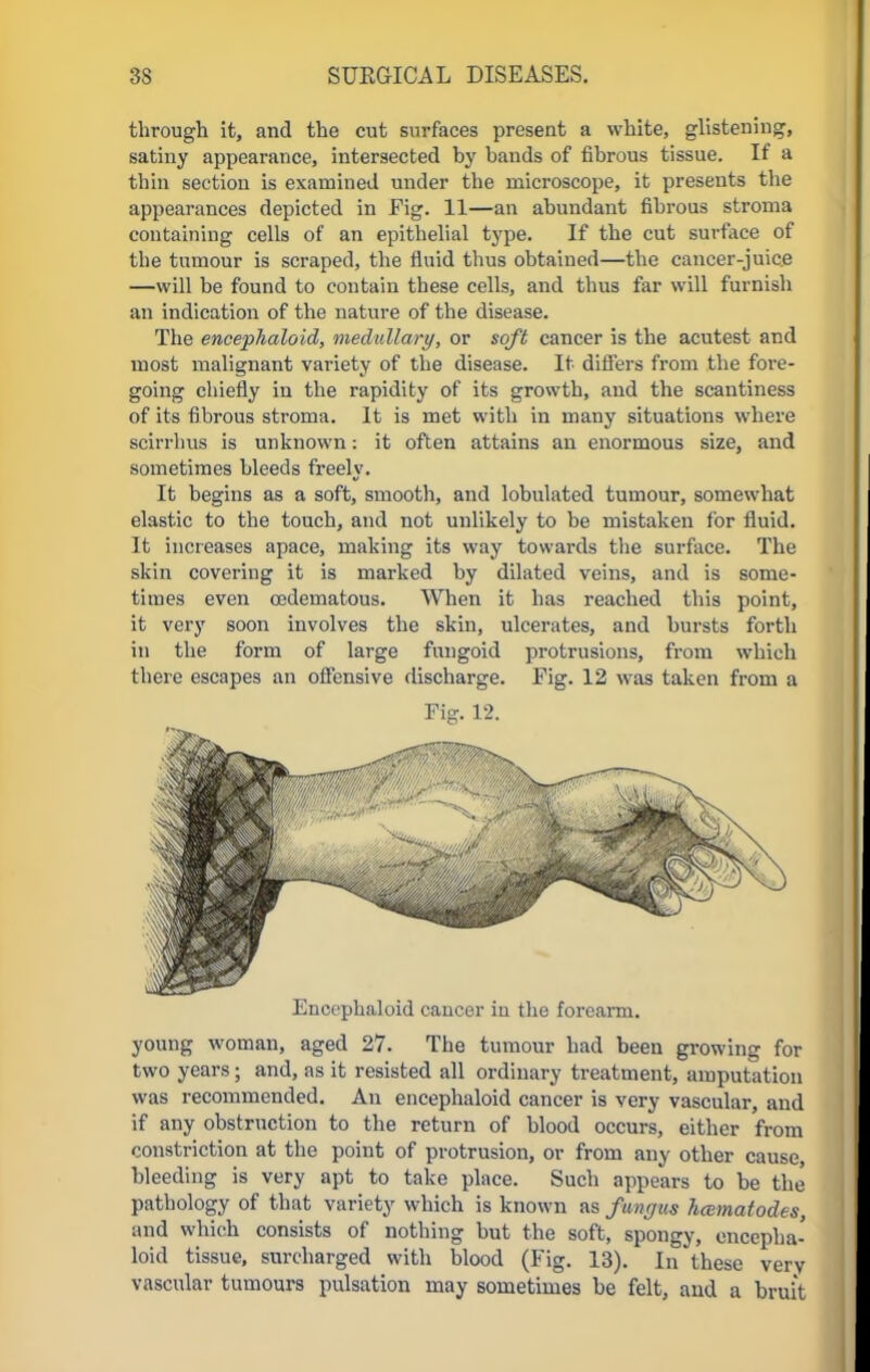 through it, and the cut surfaces present a white, glistening, satiny appearance, intersected by bands of fibrous tissue. If a thin section is examined under the microscope, it presents the appearances depicted in Fig. 11—an abundant fibrous stroma containing cells of an epithelial type. If the cut surface of the tumour is scraped, the fluid thus obtained—the cancer-juice —will be found to contain these cells, and thus far will furnish an indication of the nature of the disease. The encephaloid, medullary, or soft cancer is the acutest and most malignant variety of the disease. It differs from the fore- going chiefly in the rapidity of its growth, and the scantiness of its fibrous stroma. It is met with in many situations where scirrhus is unknown: it often attains an enormous size, and sometimes bleeds freely. It begins as a soft, smooth, and lobulated tumour, somewhat elastic to the touch, and not unlikely to be mistaken for fluid. It increases apace, making its way towards the surface. The skin covering it is marked by dilated veins, and is some- times even cedematous. When it has reached this point, it very soon involves the skin, ulcerates, and bursts forth in the form of large fungoid protrusions, from which there escapes an offensive discharge. Fig. 12 was taken from a Fig. 12. Encephaloid cancer in the forearm. young woman, aged 27. The tumour had been growing for two years; and, as it resisted all ordinary treatment, amputation was recommended. An encephaloid cancer is very vascular, and if any obstruction to the return of blood occurs, either from constriction at the point of protrusion, or from any other cause bleeding is very apt to take place. Such appears to be the pathology of that variety which is known as fungus hcematodes, and which consists of nothing but the soft, spongy, encepha- loid tissue, surcharged with blood (Fig. 13). In these very vascular tumours pulsation may sometimes be felt, and a bruit