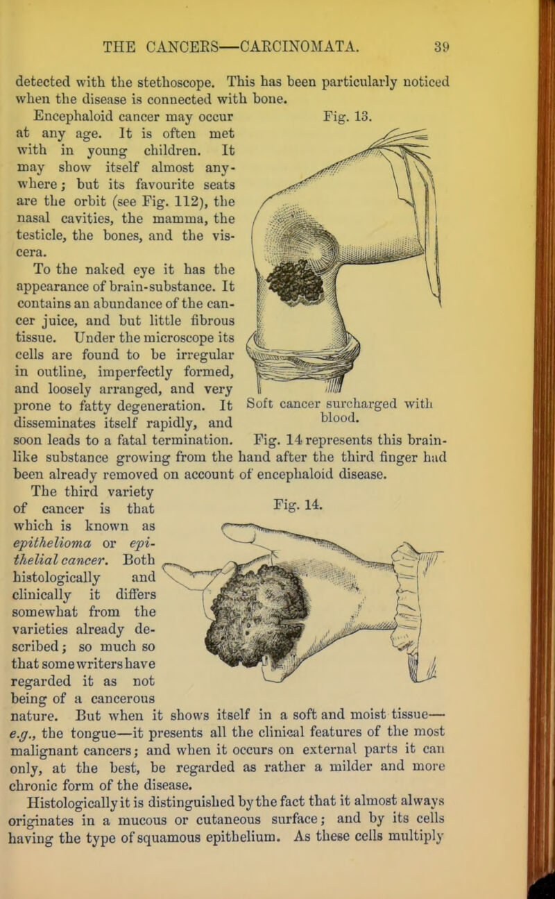 detected with the stethoscope. This has been particularly noticed when the disease is connected with hone. Encephaloid cancer may occur at any age. It is often met with in young children. It may show itself almost any- where ; but its favourite seats are the orbit (see Fig. 112), the nasal cavities, the mamma, the testicle, the bones, and the vis- cera. To the naked eye it has the appearance of brain-substance. It contains an abundance of the can- cer juice, and but little fibrous tissue. Under the microscope its cells are found to be irregular in outline, imperfectly formed, and loosely arranged, and very prone to fatty degeneration. It disseminates itself rapidly, and soon leads to a fatal termination. Fig. 13. Soft cancer surcharged with blood. Fig. 14 represents this brain- like substance growing from the hand after the third finger hud been already removed on account of encephaloid disease. The third variety of cancer is that Fig. 14. which is known as epithelioma or epi- thelial cancer. Both histologically and clinically it differs somewhat from the varieties already de- scribed; so much so that some writers have regarded it as not a cancerous But when it shows itself in a soft and moist tissue— e.g., the tongue—it presents all the clinical features of the most malignant cancers; and when it occurs on external parts it can only, at the best, be regarded as rather a milder and more chronic form of the disease. Histologically it is distinguished by the fact that it almost always originates in a mucous or cutaneous surface; and by its cells having the type of squamous epithelium. As these cells multiply being of nature