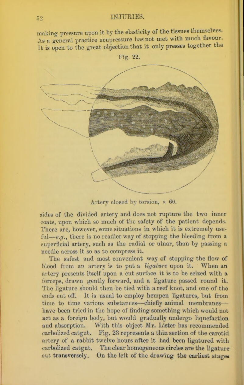 gg INJURIES. making pressure upon it by the elasticity of the tissues themselves. As a general practice acupressure lias not met with much favour. It is open to the great objection that it only presses together the Fig. 22. Artery closed by torsion, x 60. sides of the divided artery and does not rupture the two inner coats, upon which so much of the safety of the patient depends. There are, however, some situations in which it is extremely use- ful—e.g., there is no readier way of stopping the bleeding from a superficial artery, such as the radial or ulnar, than by passing a needle across it so as to compress it. The safest and most convenient way of stopping the flow of blood from an artery is to put a ligature upon it. When an artery presents itself upon a cut surface it is to be seized with a forceps, drawn gently forward, and a ligature passed round it. The ligature should then be tied with a reef knot, and one of the ends cut off. It is usual to employ hempen ligatures, but from time to time various substances—chiefly animal membranes— have been tried in the hope of finding something which would not act as a foreign body, but would gradually undergo liquefaction and absorption. With this object Mr. Lister has recommended carbolizod catgut. Fig. 23 represents a thin section of the carotid arlery of a rabbit twelve hours after it had been ligatured with eiirbolized catgut. The clear homogeneous circles are the ligature cut- transversely. On the left of the drawing the earliest stage*