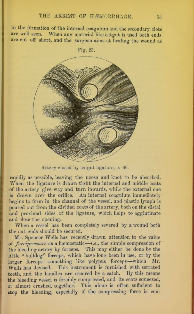 in the formation of the internal coagulum and the secondary clots are well seen. When any material like catgut is used both ends are cut off short, and the surgeon aims at healing the wound as Fig. 23. Artery closed by catgut ligature, x GO. rapidly as possible, leaving the noose and knot to be absorbed. When the ligature is drawn tight the internal and middle coats of the artery give way and turn inwards, while the external one is drawn over the orifice. An internal coagulum immediately begins to form in the channel of the vessel, and plastic lymph is poured out from the divided coats of the artery, both on the distal and proximal sides of the ligature, which helps to agglutinate and close the opening. When a vessel has been completely severed by a wound both the cut ends should be secured. Mr. Spencer Wells has recently drawn attention to the value of forcipressure as a haemostatic—i.e., the simple compression of the bleeding artery by forceps. This may either be done by the little  bulldog forceps, which have long been in use, or by the larger forceps—something like polypus forceps—which Mr. Wells has devised. This instrument is furnished with serrated teeth, and the handles are secured by a catch. By this means the bleeding vessel is forcibly compressed, and its coats squeezed, or almost crushed, together. This alone is often sufficient to stop the bleeding, especially if the compressing force is con-