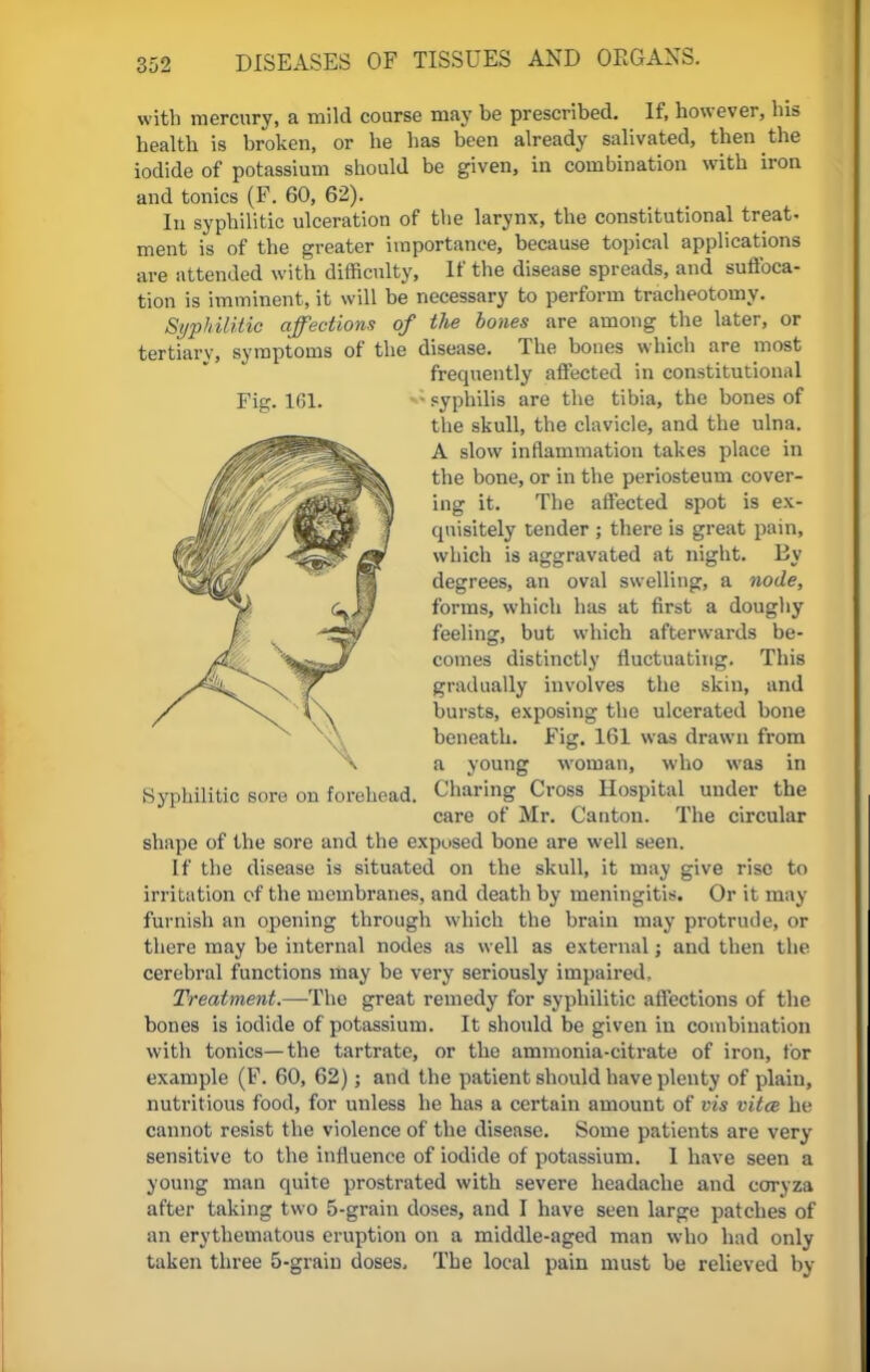 Pic. 161. with mercury, a mild course may be prescribed. If, however, his health is broken, or he has been already salivated, then the iodide of potassium should be given, in combination with iron and tonics (F. 60, 62). In syphilitic ulceration of the larynx, the constitutional treat, ment is of the greater importance, because topical applications are attended with difficulty, If the disease spreads, and suffoca- tion is imminent, it will be necessary to perform tracheotomy. Syphilitic affections of tlie bones are among the later, or tertiary, symptoms of the disease. The bones which are most frequently affected in constitutional syphilis are the tibia, the bones of the skull, the clavicle, and the ulna. A slow inflammation takes place in the bone, or in the periosteum cover- ing it. The affected spot is ex- quisitely tender ; there is great pain, which is aggravated at night. By degrees, an oval swelling, a node, forms, which has at first a doughy feeling, but which afterwards be- comes distinctly fluctuating. This gradually involves the skin, and bursts, exposing the ulcerated bone beneath. Fig. 161 was drawn from a young woman, who was in Charing Cross Hospital under the care of Mr. Canton. The circular shape of the sore and the exposed bone are well seen. If the disease is situated on the skull, it may give rise to irritation of the membranes, and death by meningitis. Or it may furnish an opening through which the brain may protrude, or there may be internal nodes as well as external; and then the cerebral functions may be very seriously impaired. Treatment.—-The great remedy for syphilitic affections of the bones is iodide of potassium. It should be given in combination with tonics—the tartrate, or the ammonia-citrate of iron, for example (F. 60, 62); and the patient should have plenty of plain, nutritious food, for unless he has a certain amount of vis vitce he cannot resist the violence of the disease. Some patients are very sensitive to the influence of iodide of potassium. I have seen a young man quite prostrated with severe headache and corvza after taking two 5-grain doses, and I have seen large patches of an erythematous eruption on a middle-aged man who had only taken three 5-grain doses. The local pain must be relieved by-