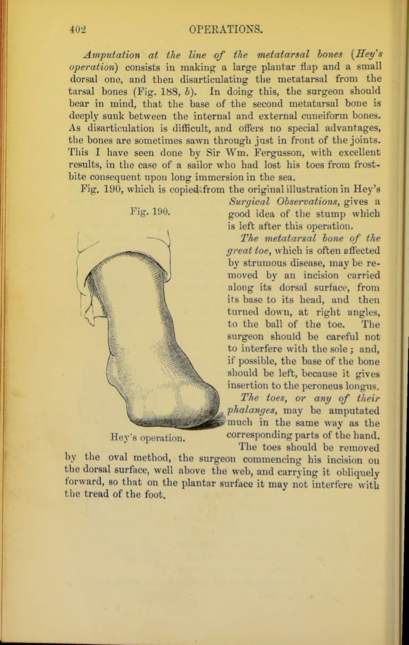 Amputation at the line of the metatarsal bones {Hey's operation) consists in making a large plantar flap and a small dorsal one, and then disarticulating the metatarsal from the tarsal bones (Fig. 188, b). In doing this, the surgeon should bear in mind, that the base of the second metatarsal bone is deeply sunk between the internal and external cuneiform bones. As disarticulation is difficult, and offers no special advantages, the bones are sometimes sawn through just in front of the joints. This I have seen done by Sir Wm. Fergusson, with excellent results, in the case of a sailor who had lost his toes from frost- bite consequent upon long immersion in the sea. Fig. 190, which is copied-from the original illustration in Hey's Surgical Observations, gives a good idea of the stump which is left after this operation. The metatarsal bone of the great toe, which is often affected by strumous disease, may be re- moved by an incision carried along its dorsal surface, from its base to its head, and then turned down, at right angles, to the ball of the toe. The surgeon should be careful not to interfere with the sole ; and, if possible, the base of the bone should be left, because it gives insertion to the peroneus longus. The toes, or any of their phalanges, may be amputated much in the same way as the Hey's operation. corresponding parts of the hand. The toes should be removed by the oval method, the surgeon commencing his incision on the dorsal surface, well above the web, and carrying it obliquely forward, so that on the plantar surface it may not interfere with the tread of the foot.