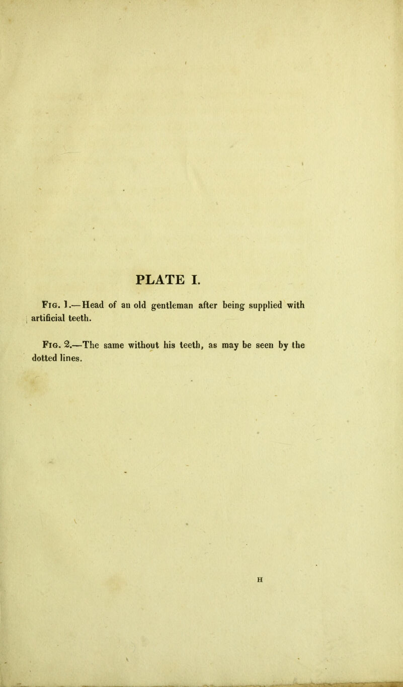 Fig. I.—Head of an old gentleman after being supplied with artificial teeth. Fig. 2.—The same without his teeth, as may be seen by the dotted lines. H y