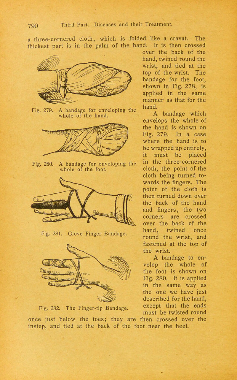 Fig. 279. A bandage for enveloping the whole of the hand. Fig. 280. A bandage for enveloping the whole of the foot. a three-cornered cloth, which is folded like a cravat. The thickest part is in the palm of the hand. It is then crossed over the back of the hand, twined round the wrist, and tied at the top of the wrist. The bandage for the foot, shown in Fig. 278, is applied in the same manner as that for the hand. A bandage which envelops the whole of the hand is shown on Fig. 279. In a case where the hand is to be wrapped up entirely, it must be placed in the three-cornered cloth, the point of the cloth being turned to- wards the fingers. The point of the cloth is then turned down over the back of the hand and fingers, the two corners are crossed over the back of the hand, twined once round the wrist, and fastened at the top of the wrist. A bandage to en- velop the whole of the foot is shown on Fig. 280. It is applied in the same way as the one we have just described for the hand, Fig. 282. The Finger-tip Bandage. excePt that the ends. must be twisted round once just below the toes; they are then crossed over the instep, and tied at the back of the foot near the heel. Fig. 281. Glove Finger Bandage.