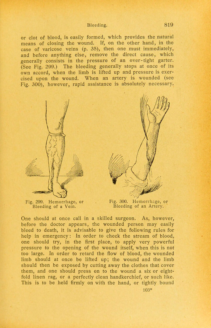 or clot of blood, is easily formed, which provides the natural means of closing the wound. If, on the other hand, in the case of varicose veins (p. 35), then one must immediately, and before anything else, remove the direct cause, which generally consists in the pressure of an over-tight garter. (See Fig. 299.) The bleeding generally stops at once of its own accord, when the limb is lifted up and pressure is exer- cised upon the wound. When an artery is wounded (see Fig. 300), however, rapid assistance is absolutely necessary. Fig. 299. Hemorrhage, or Fig. 300. Hemorrhage, or Bleeding of a Vein. Bleeding of an Artery. One should at once call in a skilled surgeon. As, however, before the doctor appears, the wounded person may easily bleed to death, it is advisable to give the following rules for help in emergency: In order to check the stream of blood, one should try, in the first place, to apply very powerful pressure to the opening of the wound itself, when this is not too large. In order to retard the flow of blood, the wounded limb should at once be lifted up; the wound and the limb should then be exposed by cutting away the clothes that cover them, and one should press on to the wound a six or eight- fold linen rag, or a perfectly clean handkerchief, or such like. This is to be held firmly on with the hand, or tightly bound 103*