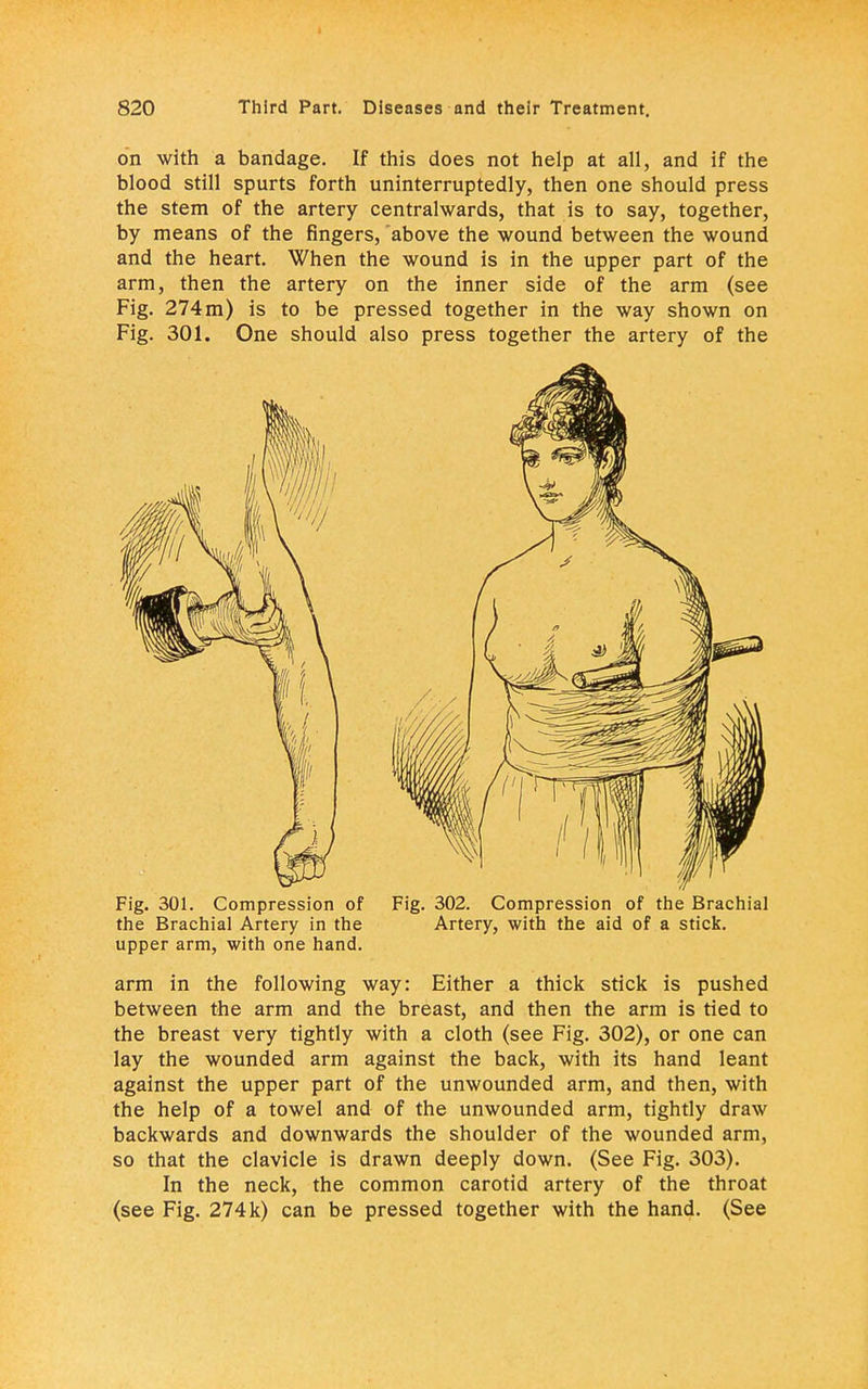 on with a bandage. If this does not help at all, and if the blood still spurts forth uninterruptedly, then one should press the stem of the artery centralwards, that is to say, together, by means of the fingers, above the wound between the wound and the heart. When the wound is in the upper part of the arm, then the artery on the inner side of the arm (see Fig. 274 m) is to be pressed together in the way shown on Fig. 301. One should also press together the artery of the Fig. 301. Compression of the Brachial Artery in the upper arm, with one hand. Fig. 302. Compression of the Brachial Artery, with the aid of a stick. arm in the following way: Either a thick stick is pushed between the arm and the breast, and then the arm is tied to the breast very tightly with a cloth (see Fig. 302), or one can lay the wounded arm against the back, with its hand leant against the upper part of the unwounded arm, and then, with the help of a towel and of the unwounded arm, tightly draw backwards and downwards the shoulder of the wounded arm, so that the clavicle is drawn deeply down. (See Fig. 303). In the neck, the common carotid artery of the throat (see Fig. 274k) can be pressed together with the hand. (See