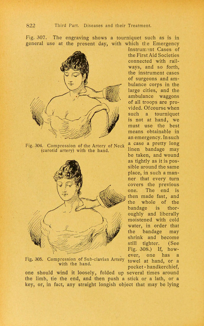 Fig. 304. Compression of the Artery of Neck (carotid artery) with the hand. Fig. 307. The engraving shows a tourniquet such as is in general use at the present day, with which the Emergency Instrument Cases of the First Aid Societies connected with rail- ways, and so forth, the instrument cases of surgeons and am- bulance corps in the large cities, and the ambulance waggons of all troops are pro- vided. Of course when such a tourniquet is not at hand, we must use the best means obtainable in an emergency. In such a case a pretty long linen bandage may be taken, and wound as tightly as it is pos- sible around the same place, in such a man- ner that every turn covers the previous one. The end is then made fast, and the whole of the bandage is thor- oughly and liberally moistened with cold water, in order that the bandage may shrink and become still tighter. (See Fig. 308.) If, how- ever, one has a towel at hand, or a pocket - handkerchief, several times around stick or a lath, or a Fig. 305. Compression of Sub-clavian Artery with the hand. one should wind it loosely, folded up the limb, tie the end, and then push a key, or, in fact, any straight longish object that may be lying