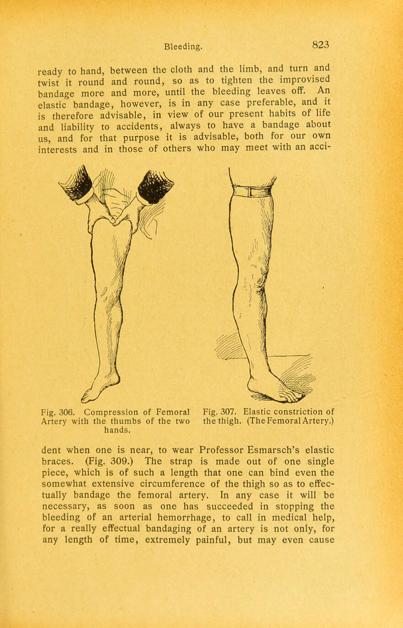 ready to hand, between the cloth and the limb, and turn and twist it round and round, so as to tighten the improvised bandage more and more, until the bleeding leaves off. An elastic bandage, however, is in any case preferable, and it is therefore advisable, in view of our present habits of life and liability to accidents, always to have a bandage about us, and for that purpose it is advisable, both for our own interests and in those of others who may meet with an acci- Fig. 306. Compression of Femoral Fig. 307. Elastic constriction of Artery with the thumbs of the two the thigh. (The Femoral Artery.) hands. dent when one is near, to wear Professor Esmarsch's elastic braces. (Fig. 309.) The strap is made out of one single piece, which is of such a length that one can bind even the somewhat extensive circumference of the thigh so as to effec- tually bandage the femoral artery. In any case it will be necessary, as soon as one has succeeded in stopping the bleeding of an arterial hemorrhage, to call in medical help, for a really effectual bandaging of an artery is not only, for any length of time, extremely painful, but may even cause