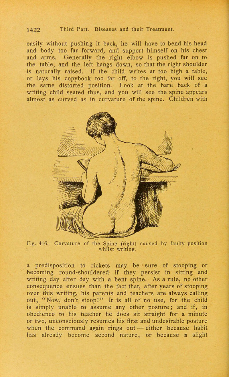 easily without pushing it back, he will have to bend his head and body too far forward, and support himself on his chest and arms. Generally the right elbow is pushed far on to the table, and the left hangs down, so that the right shoulder is naturally raised. If the child writes at too high a table, or lays his copybook too far off, to the right, you will see the same distorted position. Look at the bare back of a writing child seated thus, and you will see the spine appears almost as curved as in curvature of the spine. Children with Fig. 416. Curvature of the Spine (right) caused by faulty position whilst writing. a predisposition to rickets may be sure of stooping or becoming round-shouldered if they persist in sitting and writing day after day with a bent spine. As a rule, no other consequence ensues than the fact that, after years of stooping over this writing, his parents and teachers are always calling out, Now, don't stoop! It is all of no use, for the child is simply unable to assume any other posture; and if, in obedience to his teacher he does sit straight for a minute or two, unconsciously resumes his first and undesirable posture when the command again rings out — either because habit has already become second nature, or because a slight