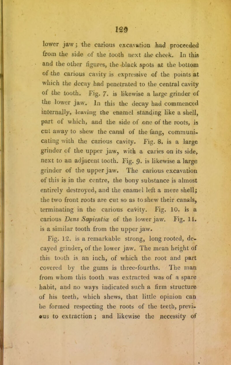 lower jaw ; the carious excavation had proceeded from the side of the tooth next the cheek. In this and the other figures, the black spots at the bottom of the carious cavity is expressive of the points at which the decay had penetrated to the central cavity of the tooth. Fig. 7. is likewise a large grinder of the lower jaw. In this the decay had commenced internally, leaving the enamel standing like a shell, part of which, and the side of one of the roots, is cut away to shew the canal of the fang, communi- cating with the carious cavity. Fig. 8. is a large grinder of the upper jaw, with a caries on its side, next to an adjacent tooth. Fig. 9* is likewise a large grinder of the upper jaw. The carious excavation of this is in the centre, the bony substance is almost entirely destroyed, and the enamel left a mere shell; the two front roots are cut so as to shew their canals, terminating in the carious cavity. Fig. 10. is a carious Dens Sapientice of the lower jaw. Fig. 11. is a similar tooth from the upper jaw. Fig. 12. is a remarkable strong, long rooted, de- cayed grinder, of the lower jaw. The mean height of this tooth is an inch, of which the root and part covered by the gums is three-fourths. The man from whom this tooth was extracted was of a spare habit, and no ways indicated such a firm structure of his teeth, which shews, that little opinion can be formed respecting the roots of the teeth, previ- ous to extraction ; and likewise the necessity of