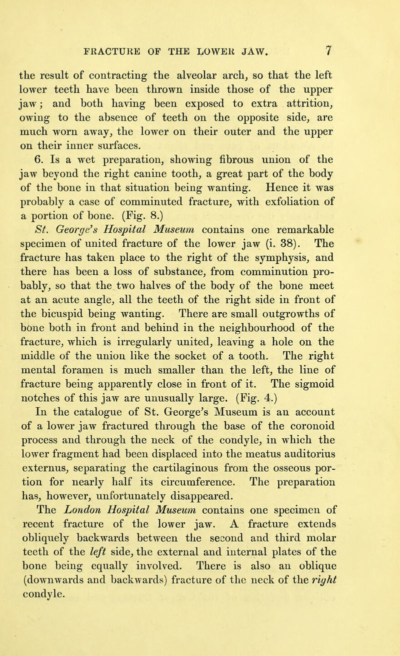 the result of contracting the alveolar arch, so that the left lower teeth have been thrown inside those of the upper jaw; and both having been exposed to extra attrition, owing to the absence of teeth on the opposite side, are much worn away, the lower on their outer and the upper on their inner surfaces. 6. Is a wet preparation, showing fibrous union of the jaw beyond the right canine tooth, a great part of the body of the bone in that situation being wanting. Hence it was probably a case of comminuted fracture, with exfoliation of a portion of bone. (Fig. 8.) St. George's Hospital Museum contains one remarkable specimen of united fracture of the lower jaw (i. 38). The fracture has taken place to the right of the symphysis, and there has been a loss of substance, from comminution pro- bably, so that the two halves of the body of the bone meet at an acute angle, all the teeth of the right side in front of the bicuspid being wanting. There are small outgrowths of bone both in front and behind in the neighbourhood of the fracture, which is irregularly united, leaving a hole on the middle of the union like the socket of a tooth. The right mental foramen is much smaller than the left, the line of fracture being apparently close in front of it. The sigmoid notches of this jaw are unusually large. (Pig. 4.) In the catalogue of St. George's Museum is an account of a lower jaw fractured through the base of the coronoid process and through the neck of the condyle, in which the lower fragment had been displaced into the meatus auditorius externus, separating the cartilaginous from the osseous por- tion for nearly half its circumference. The preparation has, however, unfortunately disappeared. The London Hospital Museum contains one specimen of recent fracture of the lower jaw. A fracture extends obliquely backwards between the second and third molar teeth of the left side, the external and internal plates of the bone being equally involved. There is also an oblique (downwards and backwards) fracture of the neck of the right condyle.