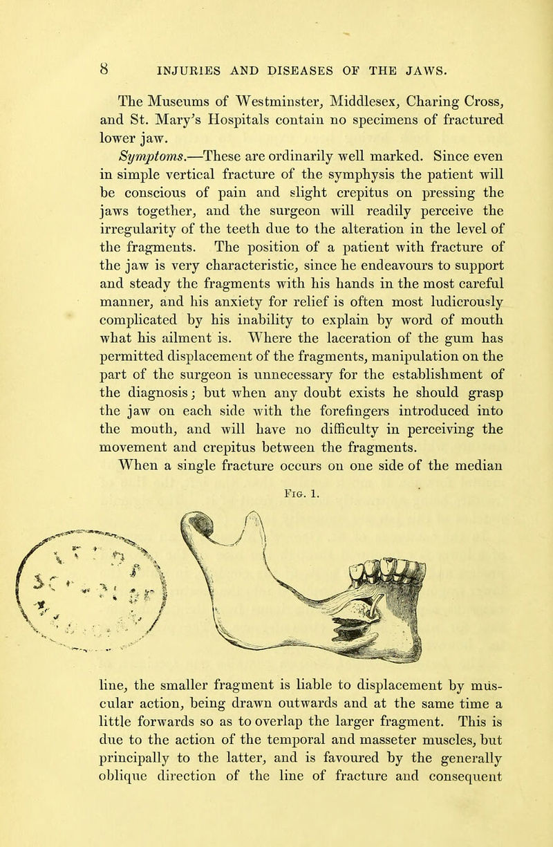 The Museums of Westminster, Middlesex, Charing Cross, and St. Mary's Hospitals contain no specimens of fractured lower jaw. Symptoms.—These are ordinarily well marked. Since even in simple vertical fracture of the symphysis the patient will be conscious of pain and slight crepitus on pressing the jaws together, and the surgeon will readily perceive the irregularity of the teeth due to the alteration in the level of the fragments. The position of a patient with fracture of the jaw is very characteristic, since he endeavours to support and steady the fragments with his hands in the most careful manner, and his anxiety for relief is often most ludicrously complicated by his inability to explain by word of mouth what his ailment is. Where the laceration of the gum has permitted displacement of the fragments, manipulation on the part of the surgeon is unnecessary for the establishment of the diagnosis; but when any doubt exists he should grasp the jaw on each side with the forefingers introduced into the mouth, and will have no difficulty in perceiving the movement and crepitus between the fragments. When a single fracture occurs on one side of the median Fig. 1. line, the smaller fragment is liable to displacement by mus- cular action, being drawn outwards and at the same time a little forwards so as to overlap the larger fragment. This is due to the action of the temporal and masseter muscles, but principally to the latter, and is favoured by the generally oblique direction of the line of fracture and consequent