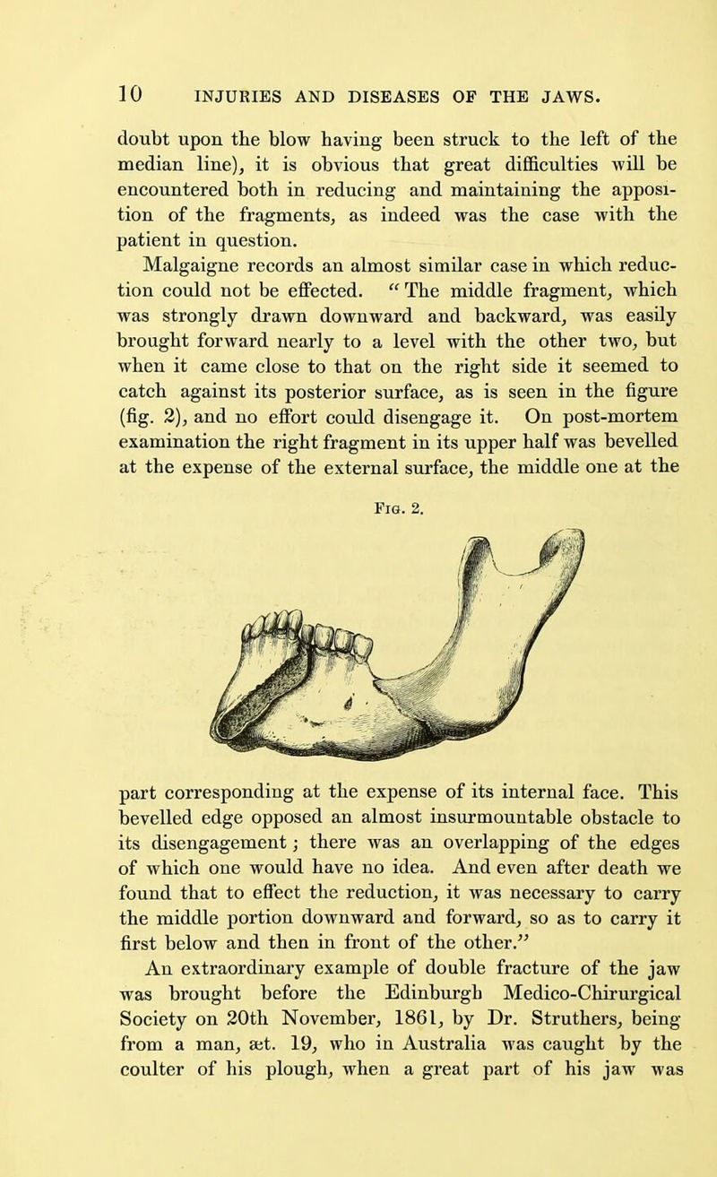 doubt upon the blow having been struck to the left of the median line), it is obvious that great difficulties will be encountered both in reducing and maintaining the apposi- tion of the fragments, as indeed was the case with the patient in question. Malgaigne records an almost similar case in which reduc- tion could not be effected.  The middle fragment, which was strongly drawn downward and backward, was easily brought forward nearly to a level with the other two, but when it came close to that on the right side it seemed to catch against its posterior surface, as is seen in the figure (fig. 2), and no effort could disengage it. On post-mortem examination the right fragment in its upper half was bevelled at the expense of the external surface, the middle one at the Fig. 2. part corresponding at the expense of its internal face. This bevelled edge opposed an almost insurmountable obstacle to its disengagement; there Avas an overlapping of the edges of which one would have no idea. And even after death we found that to effect the reduction, it was necessary to carry the middle portion downward and forward, so as to carry it first below and then in front of the other. An extraordinary example of double fracture of the jaw was brought before the Edinburgh Medico-Chirurgical Society on 20th November, 1861, by Dr. Struthers, being from a man, set. 19, who in Australia was caught by the coulter of his plough, when a great part of his jaw was