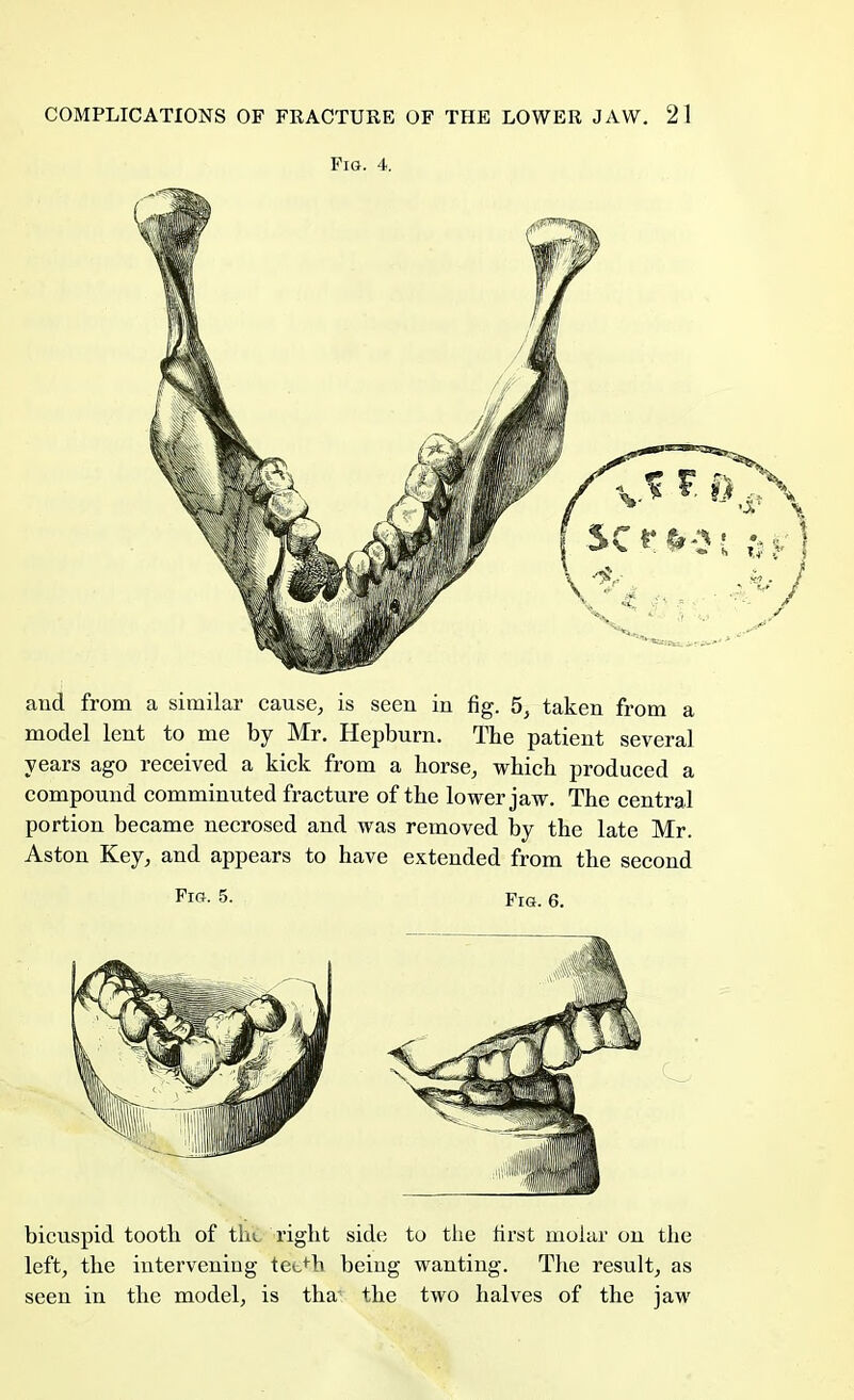 Fig. 4. and from a similar cause, is seen in fig. 5, taken from a model lent to me by Mr. Hepburn. The patient several years ago received a kick from a horse, which produced a compound comminuted fracture of the lower jaw. The central portion became necrosed and was removed by the late Mr. Aston Key, and appears to have extended from the second Fig. 5. pIG. 6. bicuspid tooth of tin right side to the first molar on the left, the intervening tet>h being wanting. The result, as seen in the model, is tha' the two halves of the jaw