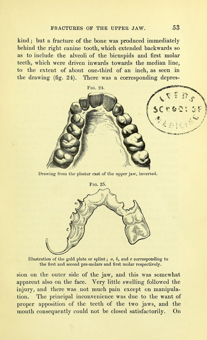 kind; but a fracture of the bone was produced immediately behind the right canine tooth, which extended backwards so as to include the alveoli of the bicuspids and first molar teeth, which were driven inwards towards the median line, to the extent of about one-third of an inch, as seen in the drawing (fig. 24). There was a corresponding depres- Ulustration of the gold plate or splint; a, b, and o corresponding to the first and second pre-molars and first molar respectively. sion on the outer side of the jaw, and this was somewhat apparent also on the face. Very little swelling followed the injury, and there was not much pain except on manipula- tion. The principal inconvenience was due to the want of proper apposition of the teeth of the two jaws, and the mouth consequently could not be closed satisfactorily. On