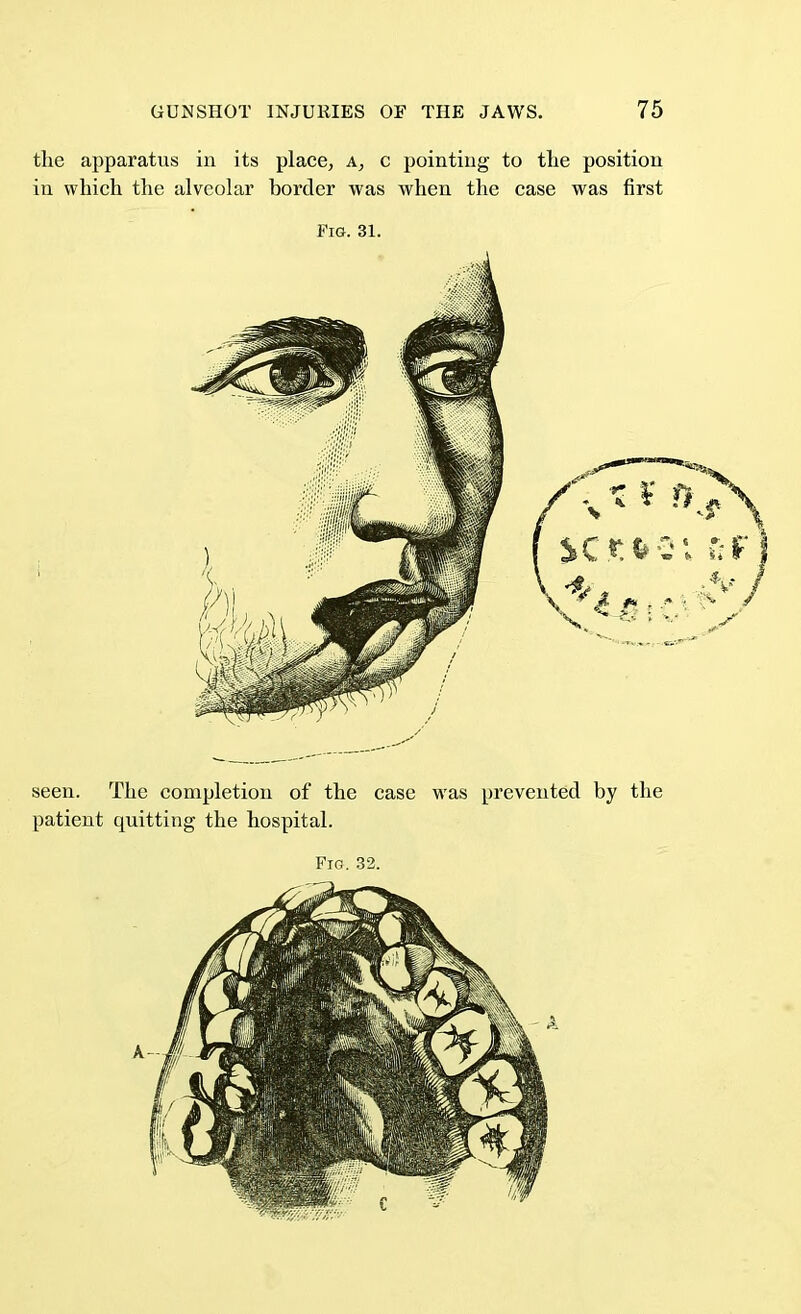 the apparatus in its place, a, c pointing to the position in which the alveolar border was when the case was first Fig. 31. seen. The completion of the case was prevented by the patient quitting the hospital.