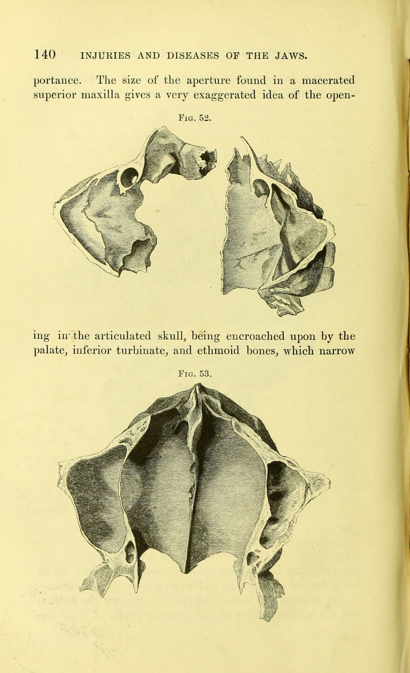 portauce. The size of the aperture found in a macerated superior maxilla gives a very exaggerated idea of the open- PiG. 52. ing in the articulated skull, being encroached upon by the palate, inferior turbinate, and ethmoid bones, which narrow