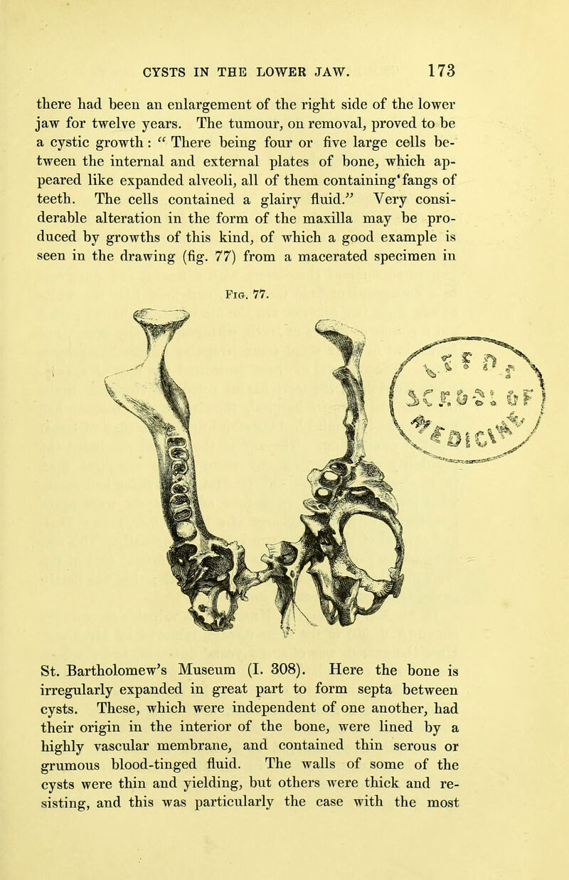 there had been an enlargement of the right side of the lower jaw for twelve years. The tumour, on removal, proved to be a cystic growth:  There being four or five large cells be- tween the internal and external plates of bone, which ap- peared like expanded alveoli, all of them containing'fangs of teeth. The cells contained a glairy fluid. Very consi- derable alteration in the form of the maxilla may be pro- duced by growths of this kind, of which a good example is seen in the drawing (fig. 77) from a macerated specimen in Fig. 77. St. Bartholomew's Museum (I. 308). Here the bone is irregularly expanded in great part to form septa between cysts. These, which were independent of one another, had their origin in the interior of the bone, were lined by a highly vascular membrane, and contained thin serous or grumous blood-tinged fluid. The walls of some of the cysts were thin and yielding, but others were thick and re- sisting, and this was particularly the case with the most