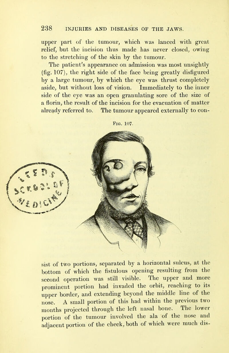 upper part of the tumour, which was lauced with great relief, but the iucisiou thus made has uever closed, owing to the stretching of the skin by the tumour. The patient's appearance on admission was most unsightly (fig. 107), the right side of the face being greatly disfigured by a large tumour, by which the eye was thrust completely aside, but without loss of vision. Immediately to the inner side of the eye was an open granulating sore of the size of a florin, the result of the incision for the evacuation of matter already referred to. The tumour appeared externally to con- sist of two portions, separated by a horizontal sulcus, at the bottom of which the fistulous opening resulting from the second operation was still visible. The upper and more prominent portion had invaded the orbit, reaching to its upper border, and extending beyond the middle line of the nose. A small portion of this had within the previous two months projected through the left nasal bone. The lower portion of the tumour involved the ala of the nose and adjacent portion of the cheek, both of which were much dis- Pig. 107. \