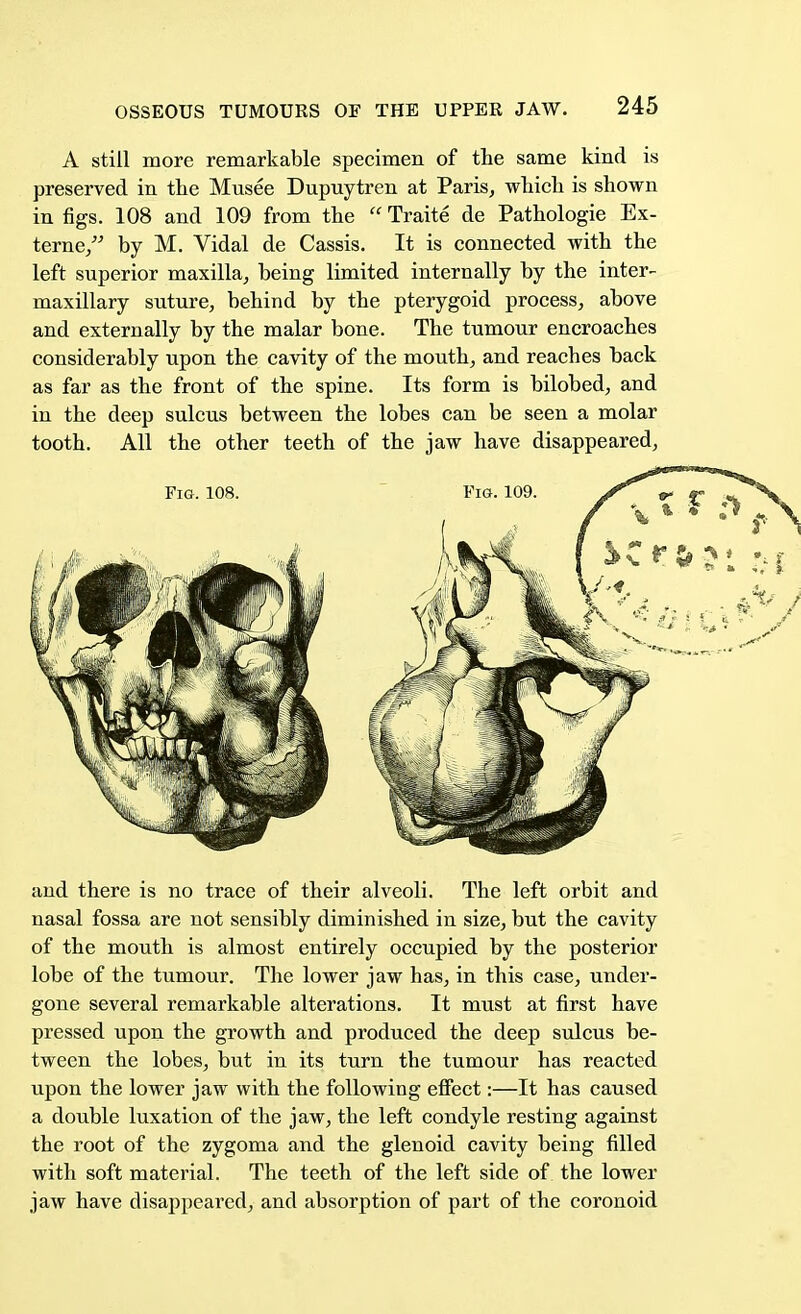 A still more remarkable specimen of the same kind is preserved in the Musee Dupuytren at Paris, which is shown in figs. 108 and 109 from the  Traite de Pathologie Ex- teme, by M. Vidal de Cassis. It is connected with the left superior maxilla, being limited internally by the inter- maxillary suture, behind by the pterygoid process, above and externally by the malar bone. The tumour encroaches considerably upon the cavity of the mouth, and reaches back as far as the front of the spine. Its form is bilobed, and in the deep sulcus between the lobes can be seen a molar tooth. All the other teeth of the jaw have disappeared, and there is no trace of their alveoli. The left orbit and nasal fossa are not sensibly diminished in size, but the cavity of the mouth is almost entirely occupied by the posterior lobe of the tumour. The lower jaw has, in this case, under- gone several remarkable alterations. It must at first have pressed upon the growth and produced the deep sulcus be- tween the lobes, but in its turn the tumour has reacted upon the lower jaw with the following effect:—It has caused a double luxation of the jaw, the left condyle resting against the root of the zygoma and the glenoid cavity being filled with soft material. The teeth of the left side of the lower jaw have disappeared, and absorption of part of the coronoid Fig. 108. Fig. 109.