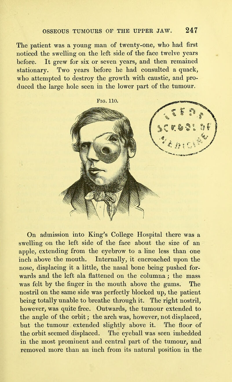 The patient was a young man of twenty-one, who had first noticed the swelling on the left side of the face twelve years before. It grew for six or seven years, and then remained stationary. Two years before he had consulted a quack, who attempted to destroy the growth with caustic, and pro- duced the large hole seen in the lower part of the tumour. Pig. 110. On admission into King's College Hospital there was a swelling on the left side of the face about the size of an apple, extending from the eyebrow to a line less than one inch above the mouth. Internally, it encroached upon the nose, displacing it a little, the nasal bone being pushed for- wards and the left ala flattened on the columna; the mass was felt by the finger in the mouth above the gums. The nostril on the same side was perfectly blocked up, the patient being totally unable to breathe through it. The right nostril, however, was quite free. Outwards, the tumour extended to the angle of the orbit; the arch was, however, not displaced, but the tumour extended slightly above it. The floor of the orbit seemed displaced. The eyeball was seen imbedded in the most prominent and central part of the tumour, and removed more than an inch from its natural position in the