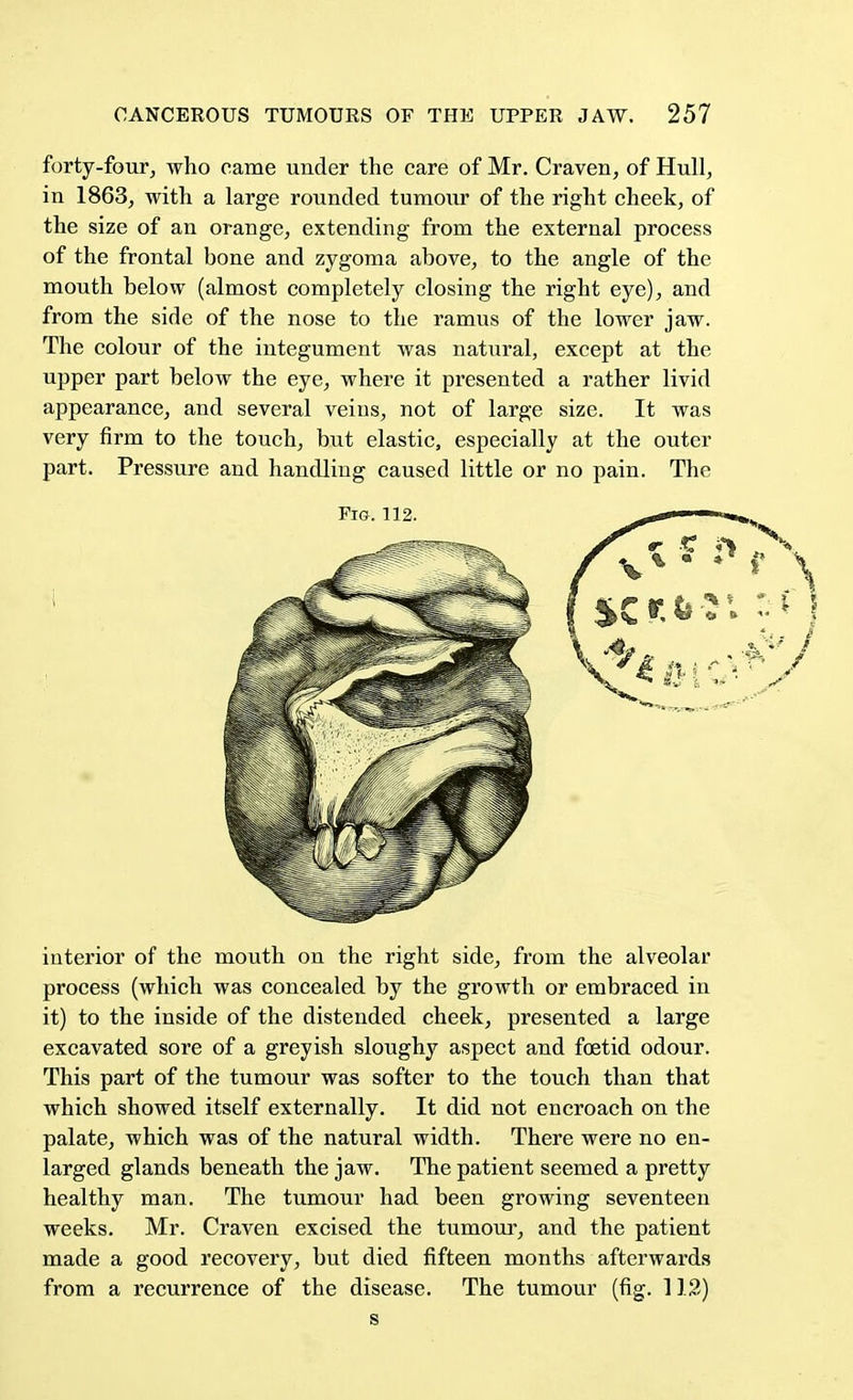 forty-four, who came under the care of Mr. Craven, of Hull, in 1863, with a large rounded tumour of the right cheek, of the size of an orange, extending from the external process of the frontal bone and zygoma above, to the angle of the mouth below (almost completely closing the right eye), and from the side of the nose to the ramus of the lower jaw. The colour of the integument was natural, except at the upper part below the eye, where it presented a rather livid appearance, and several veins, not of large size. It was very firm to the touch, but elastic, especially at the outer part. Pressure and handling caused little or no pain. The interior of the mouth on the right side, from the alveolar process (which was concealed by the growth or embraced in it) to the inside of the distended cheek, presented a large excavated sore of a greyish sloughy aspect and foetid odour. This part of the tumour was softer to the touch than that which showed itself externally. It did not encroach on the palate, which was of the natural width. There were no en- larged glands beneath the jaw. The patient seemed a pretty healthy man. The tumour had been growing seventeen weeks. Mr. Craven excised the tumour, and the patient made a good recovery, but died fifteen months afterwards from a recurrence of the disease. The tumour (fig. 112) s