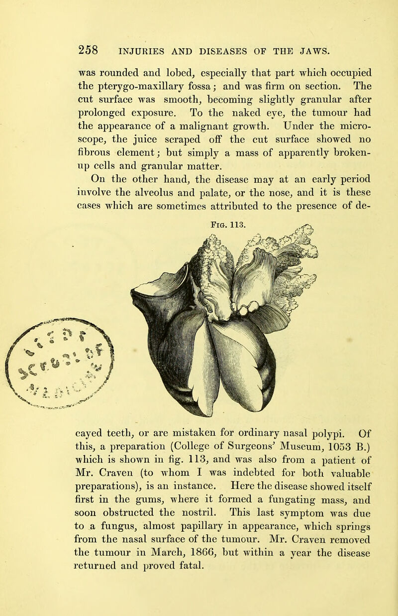 was rounded and lobed, especially that part which occupied the pterygo-maxillary fossa; and was firm on section. The cut surface was smooth, becoming slightly granular after prolonged exposure. To the naked eye, the tumour had the appearance of a malignant growth. Under the micro- scope, the juice scraped off the cut surface showed no fibrous element; but simply a mass of apparently broken- up cells and granular matter. On the other hand, the disease may at an early period involve the alveolus and palate, or the nose, and it is these cases which are sometimes attributed to the presence of de- cayed teeth, or are mistaken for ordinary nasal polypi. Of this, a preparation (College of Surgeons' Museum, 1053 B.) which is shown in fig. 113, and was also from a patient of Mr. Craven (to whom I was indebted for both valuable preparations), is an instance. Here the disease showed itself first in the gums, where it formed a fungating mass, and soon obstructed the nostril. This last symptom was due to a fungus, almost papillary in appearance, which springs from the nasal surface of the tumour. Mr. Craven removed the tumour in March, 1866, but within a year the disease returned and proved fatal.